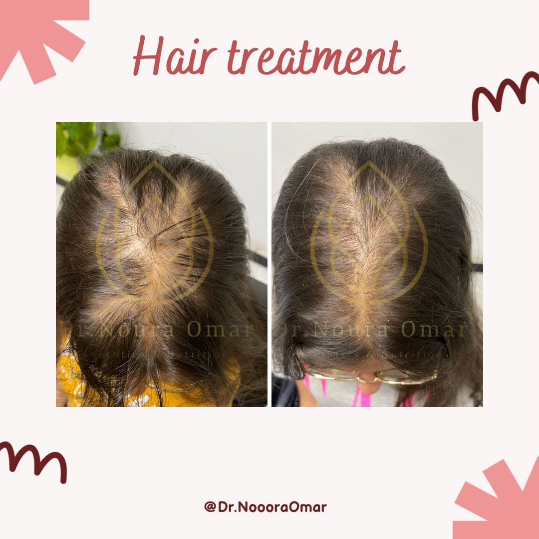 علاج الصلع الوراثي للشعر عيادة النجمة