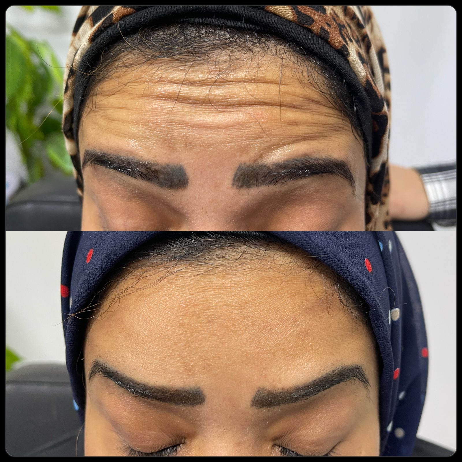 نتيجه جلسه البوتوكس للتجاعيد