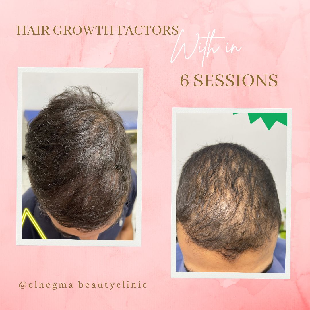 علاج تساقط الشعر عيادة النجمة