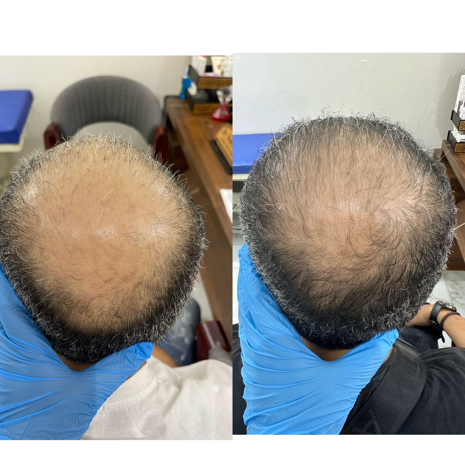 علاج الصلع الوراثي للشعر عيادة النجمة