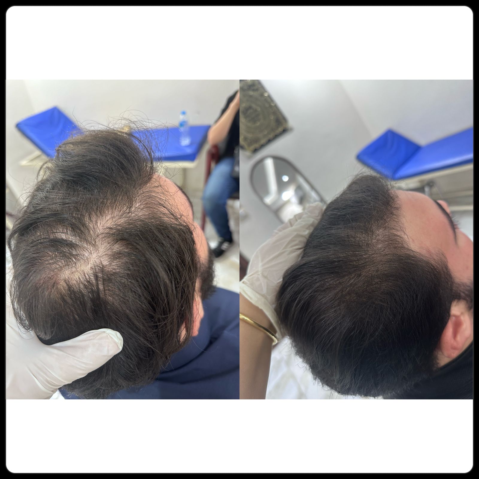 علاج الصلع الوراثي وتساقط الشعر والفراغات