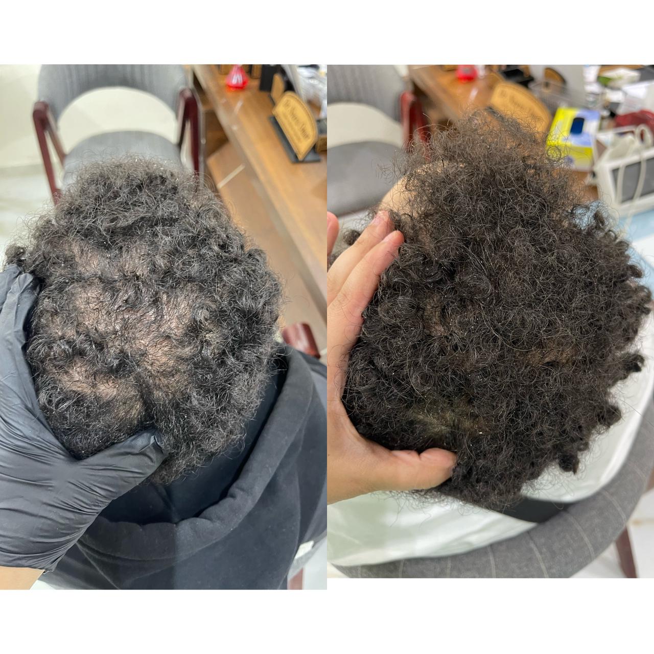 نتيجه جلسات الخلايا الجذعية قبل وبعد