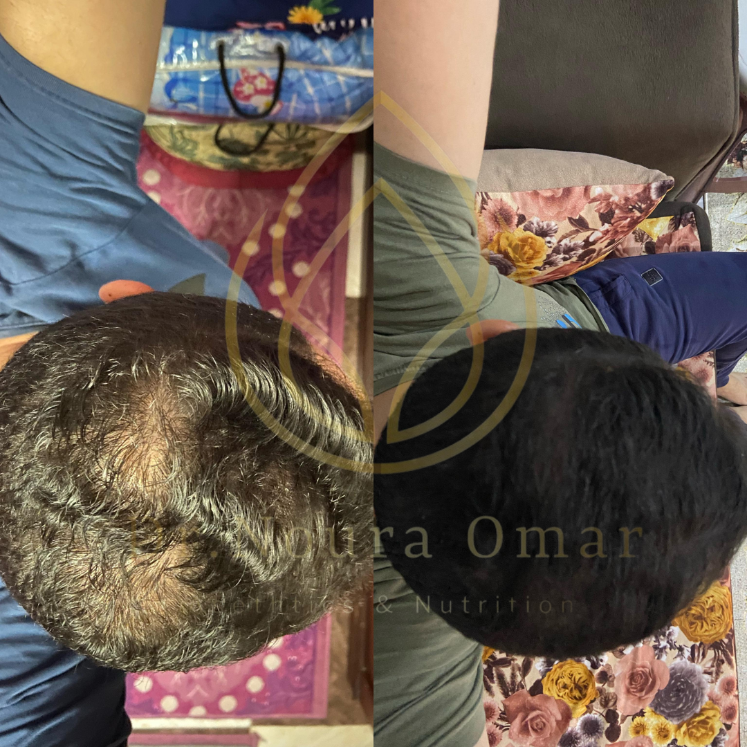 نتيجه جلسات الخلايا الجذعية قبل وبعد