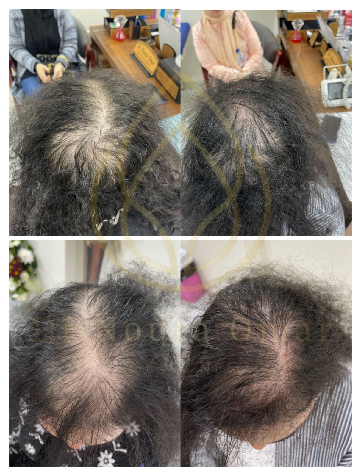 علاج تساقط الشعر عيادة النجمة