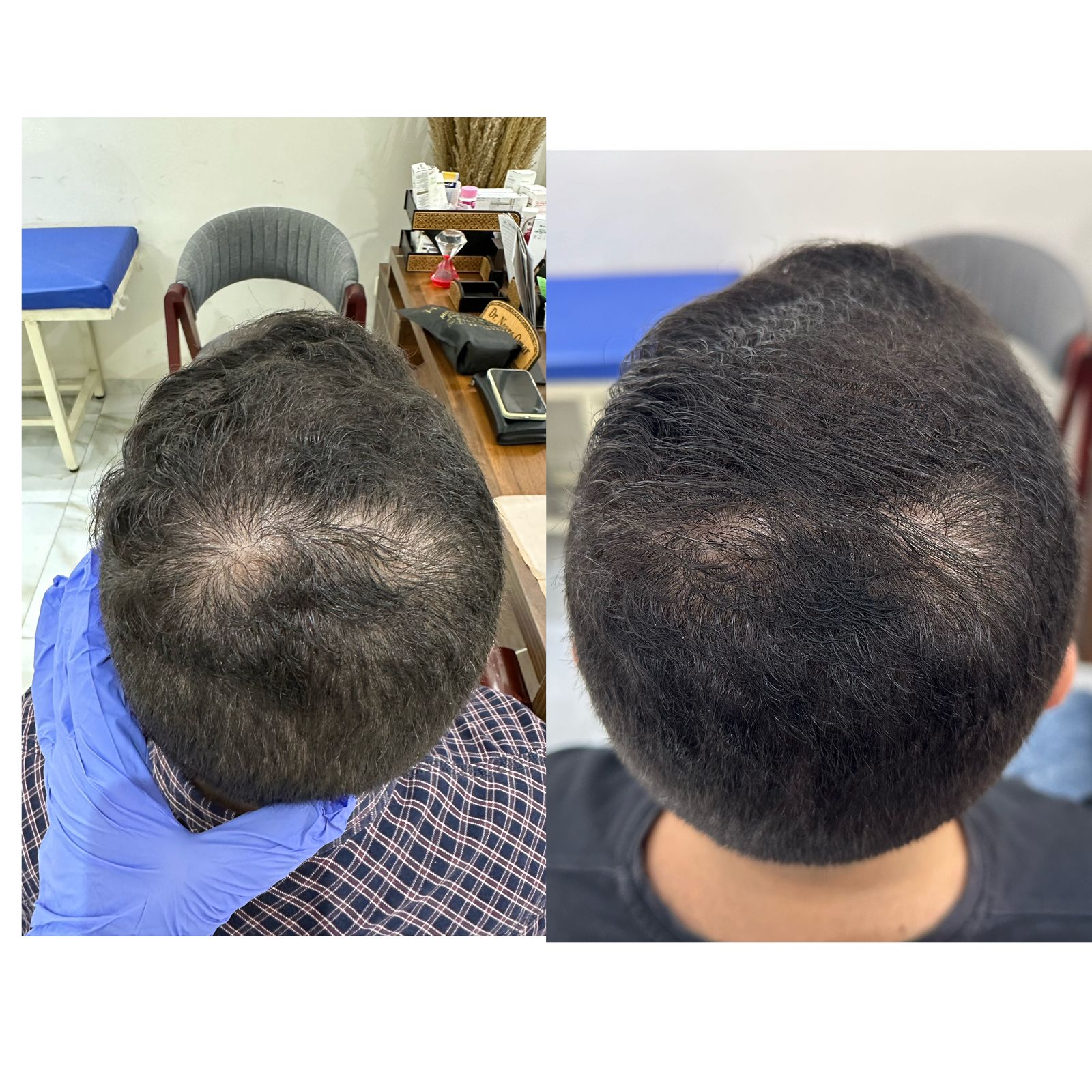 علاج تساقط الشعر عيادة النجمة