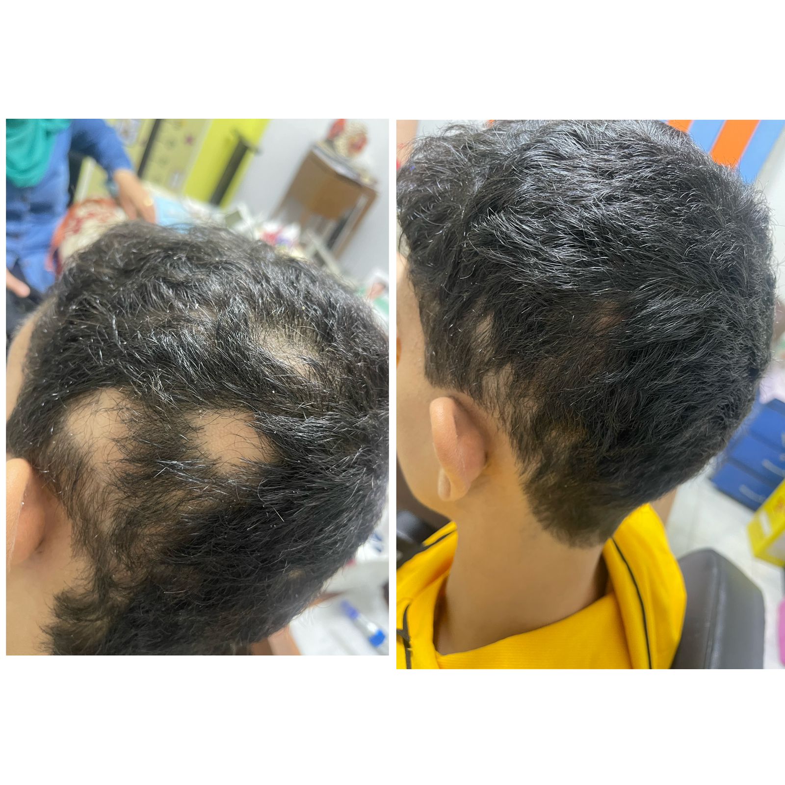 علاج ثعلبه الشعر عيادة النجمة