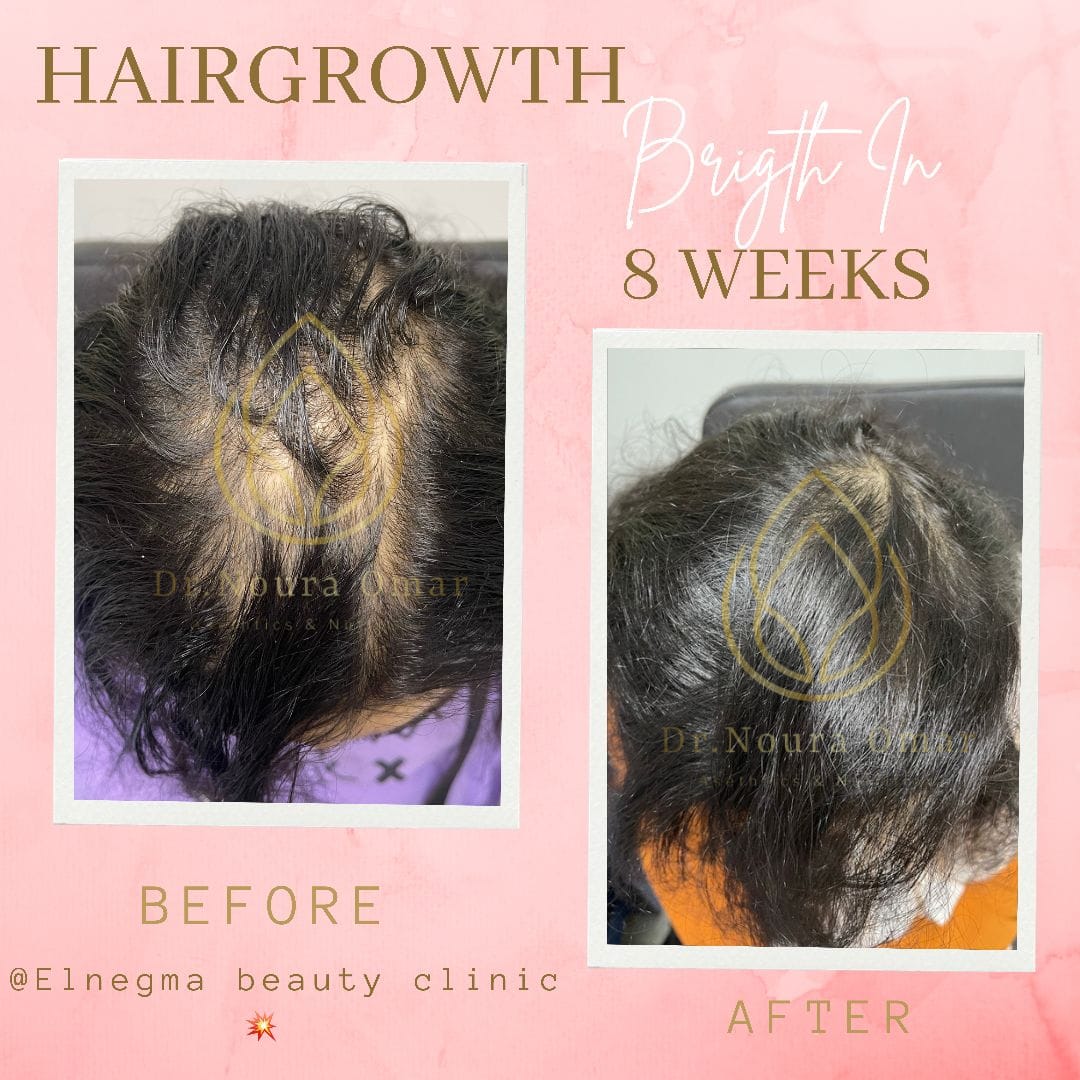 علاج الصلع الوراثي للشعر عيادة النجمة