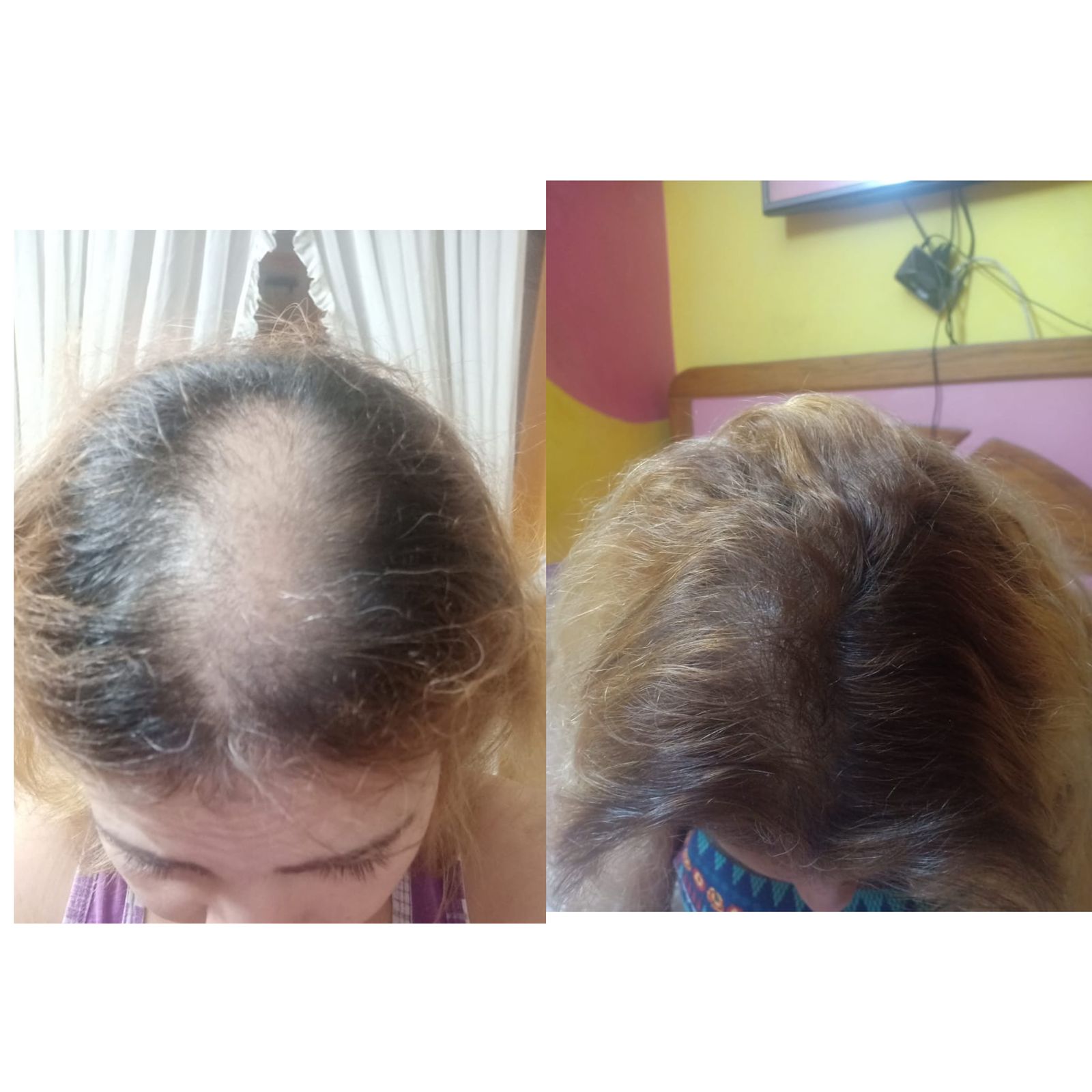 علاج الصلع الوراثي للشعر عيادة النجمة