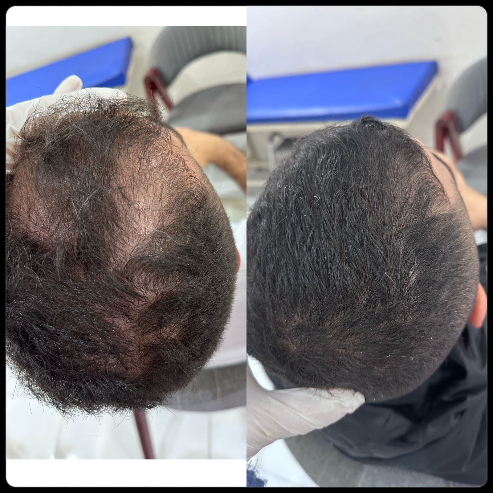 نتيجه جلسات الاكسوزوم للشعر