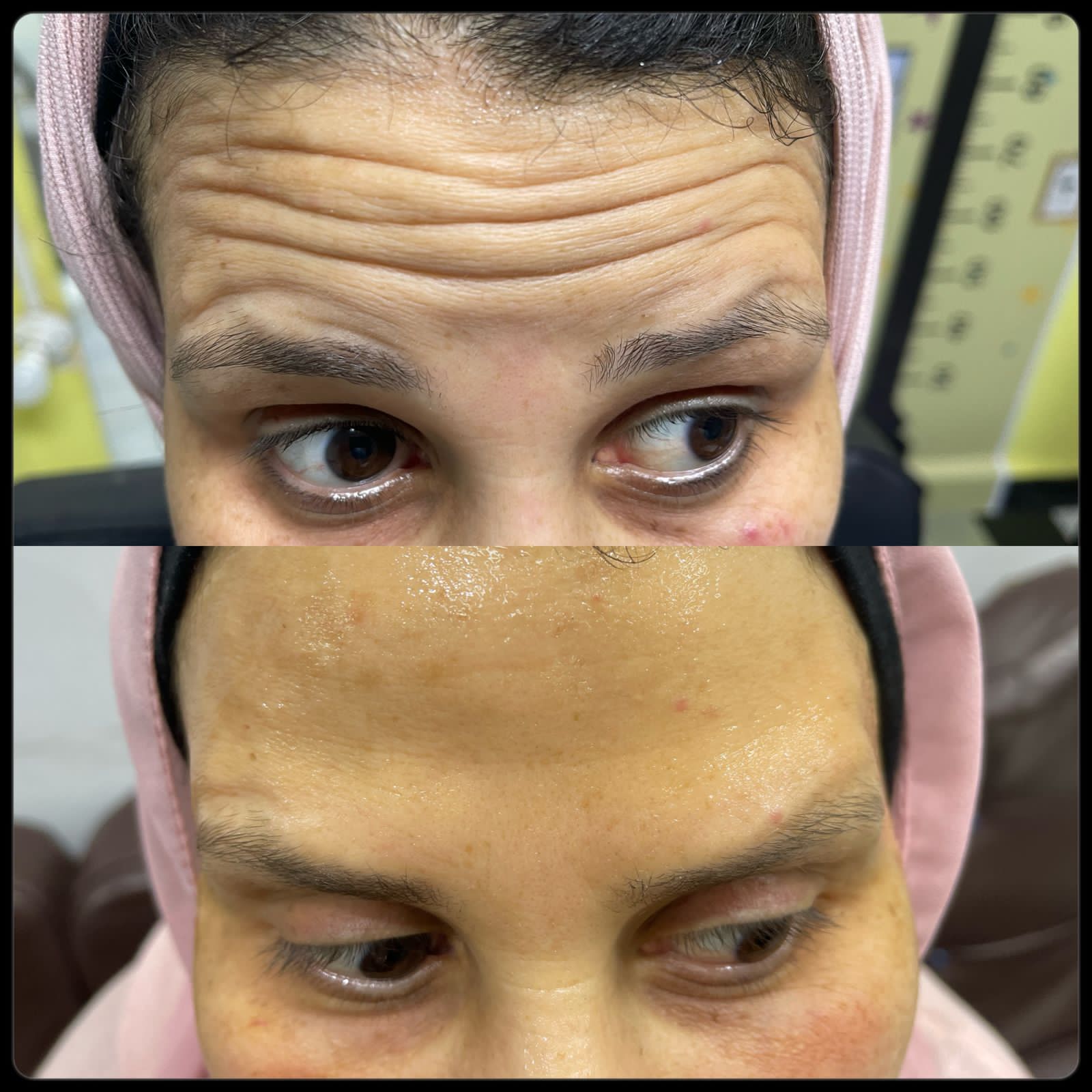 نتيجه جلسه البوتوكس للتجاعيد