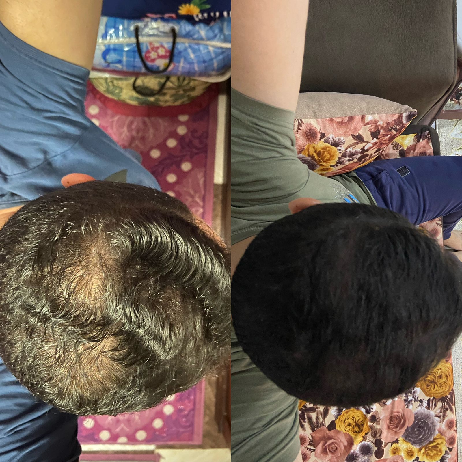 علاج ثعلبه الشعر عيادة النجمة