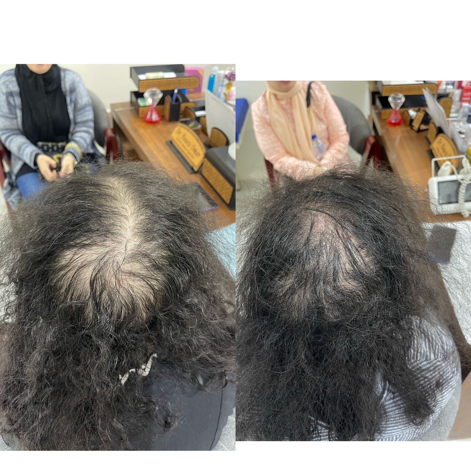 علاج الصلع الوراثي للشعر عيادة النجمة