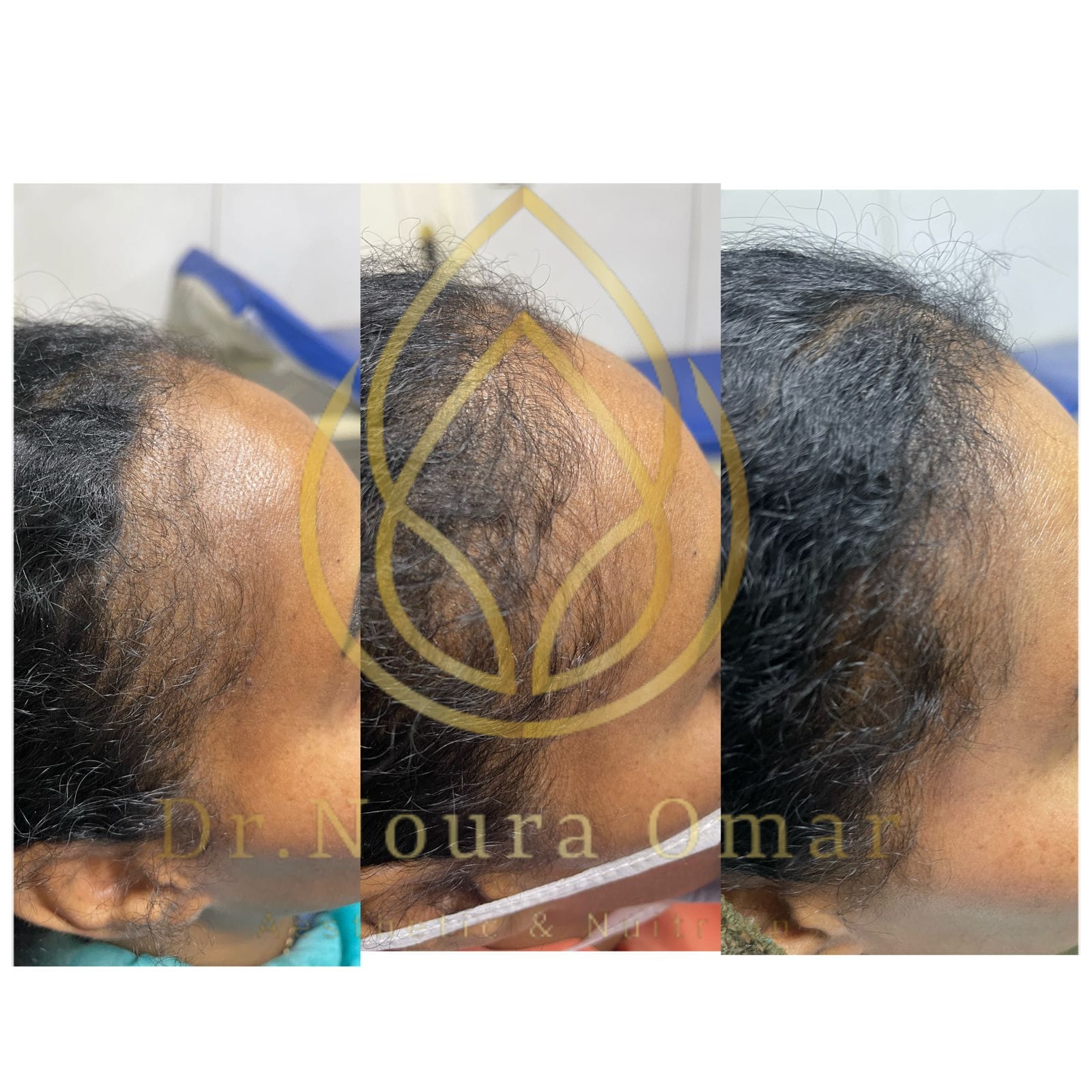 علاج الصلع الوراثي للشعر عيادة النجمة