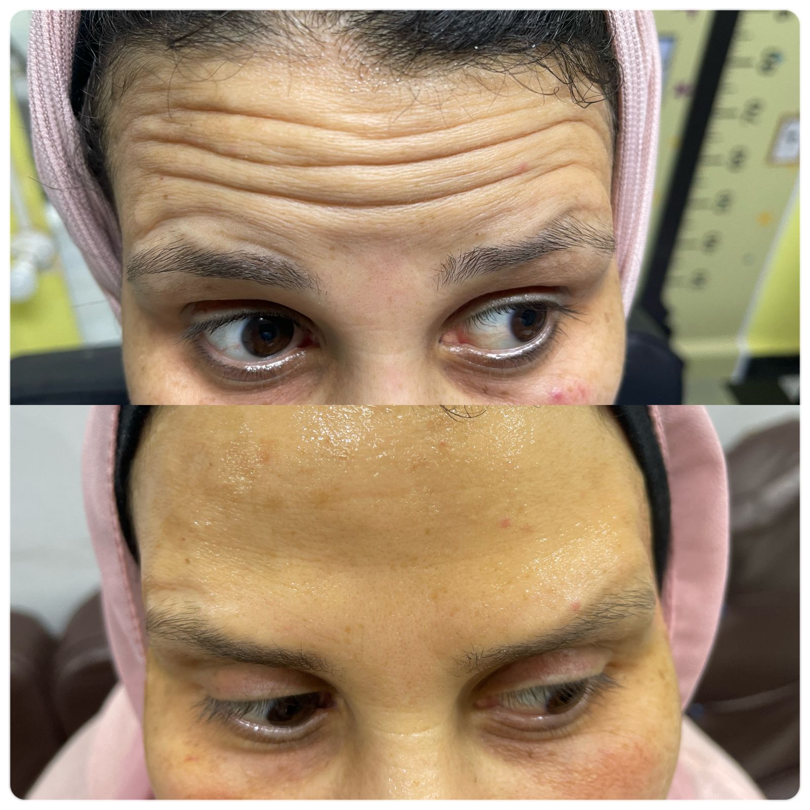 ازالة التجاعيد باستخدام البوتكس