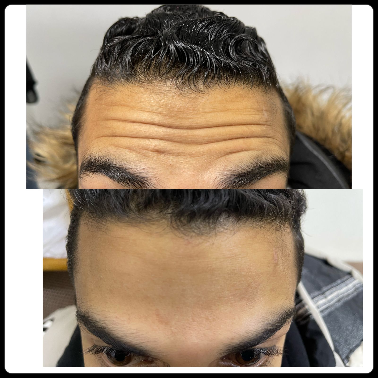 نتيجه جلسه البوتوكس للتجاعيد