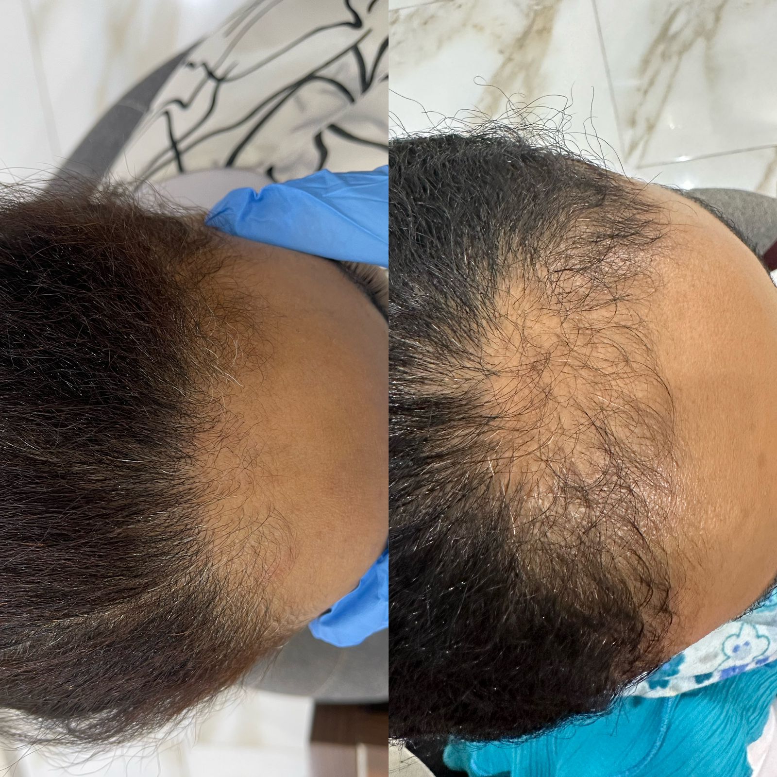 علاج الصلع الوراثي للشعر عيادة النجمة