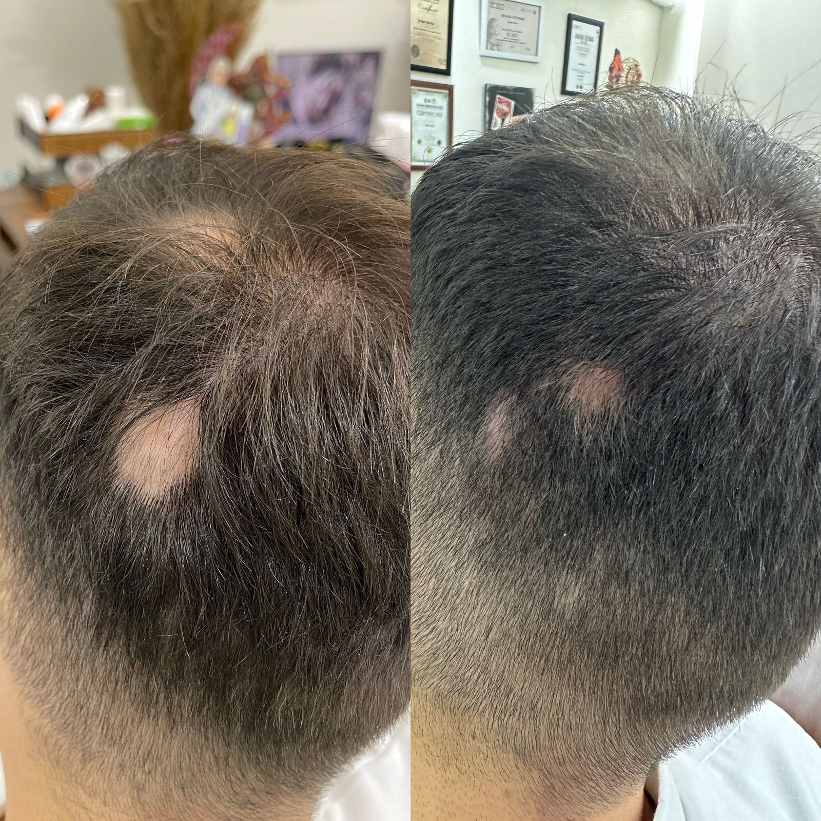 علاج ثعلبه الشعر عيادة النجمة