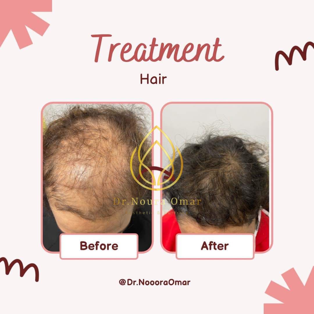 علاج الصلع الوراثي للشعر عيادة النجمة