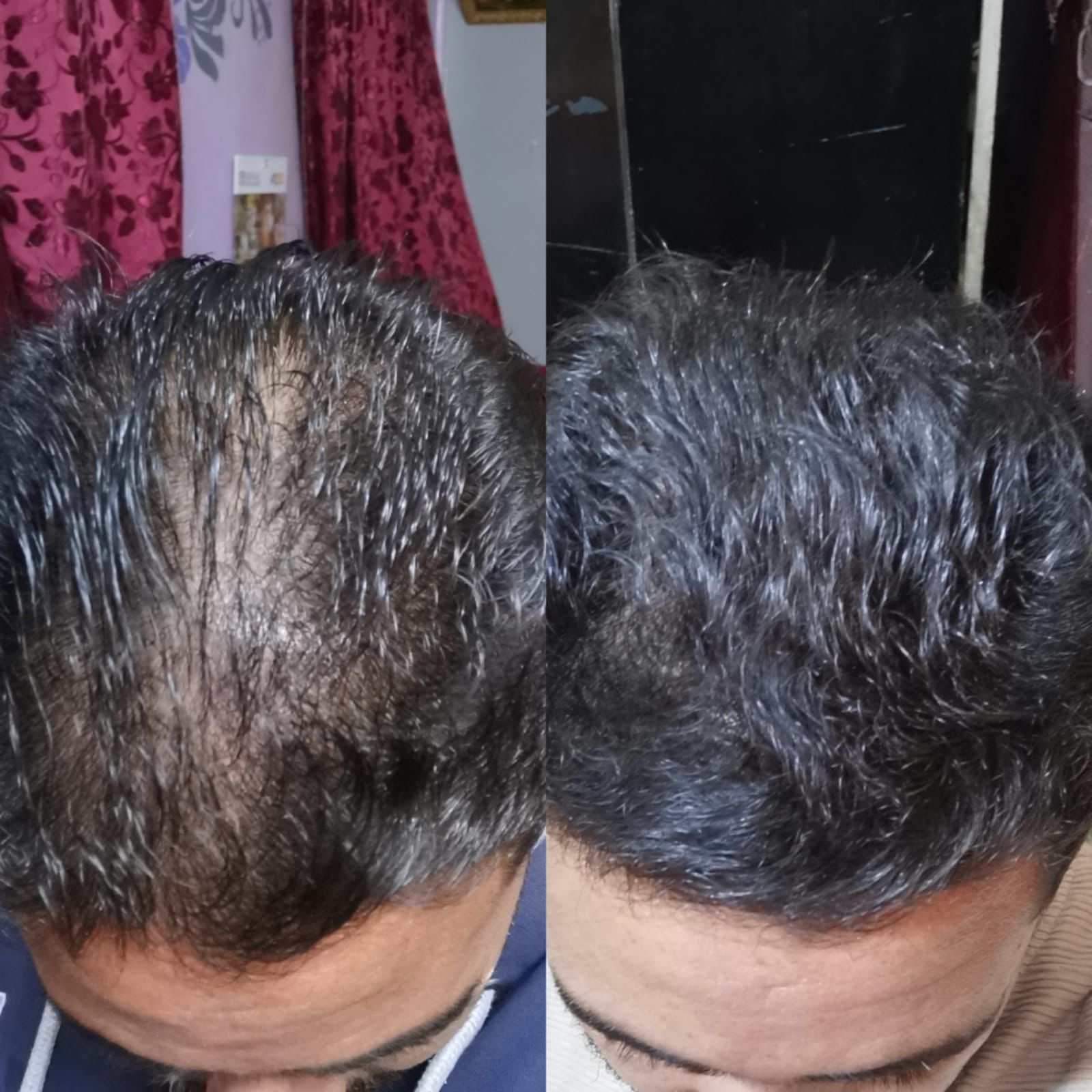 علاج الصلع الوراثي وتساقط الشعر والفراغات