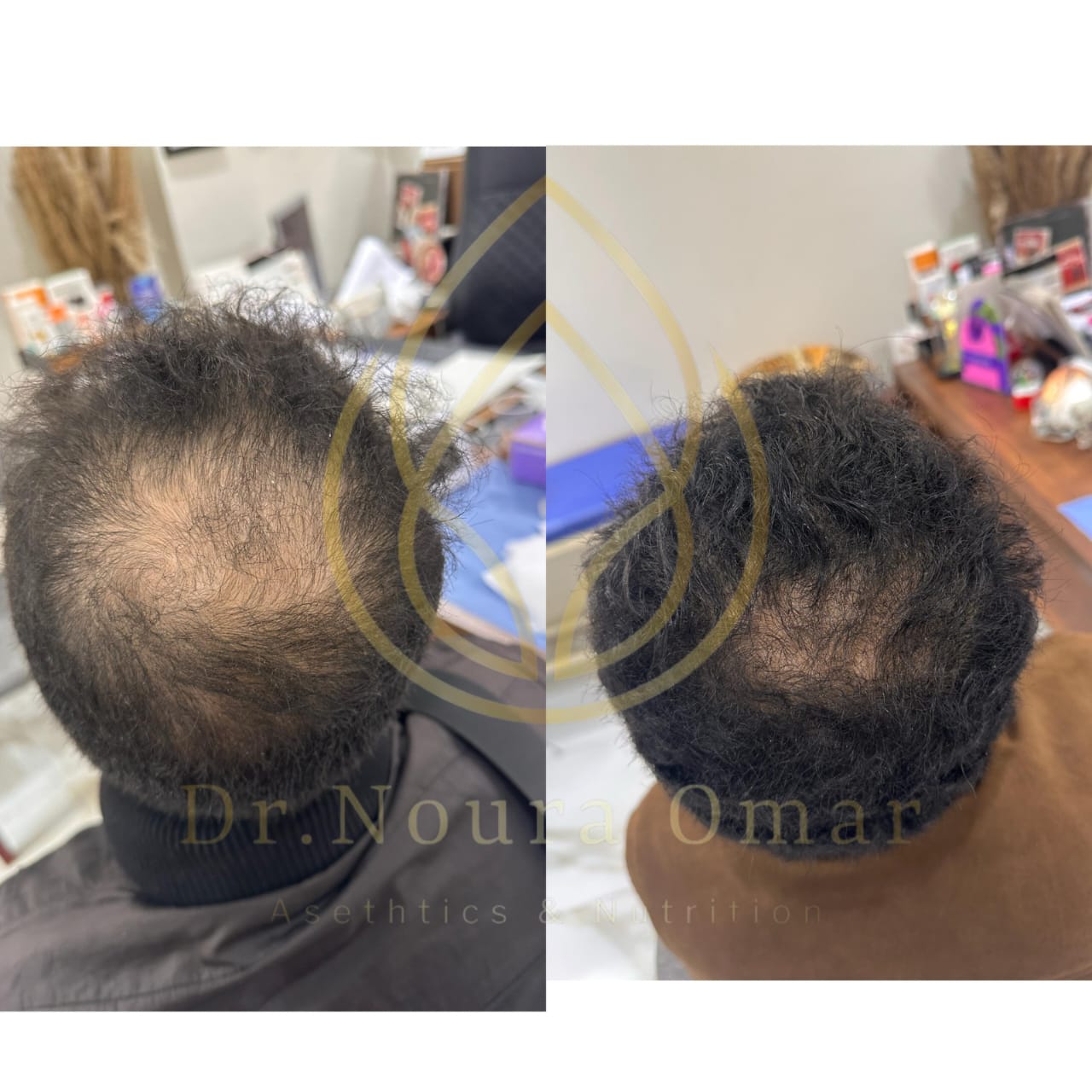 نتيجه جلسات الاكسوزوم للشعر