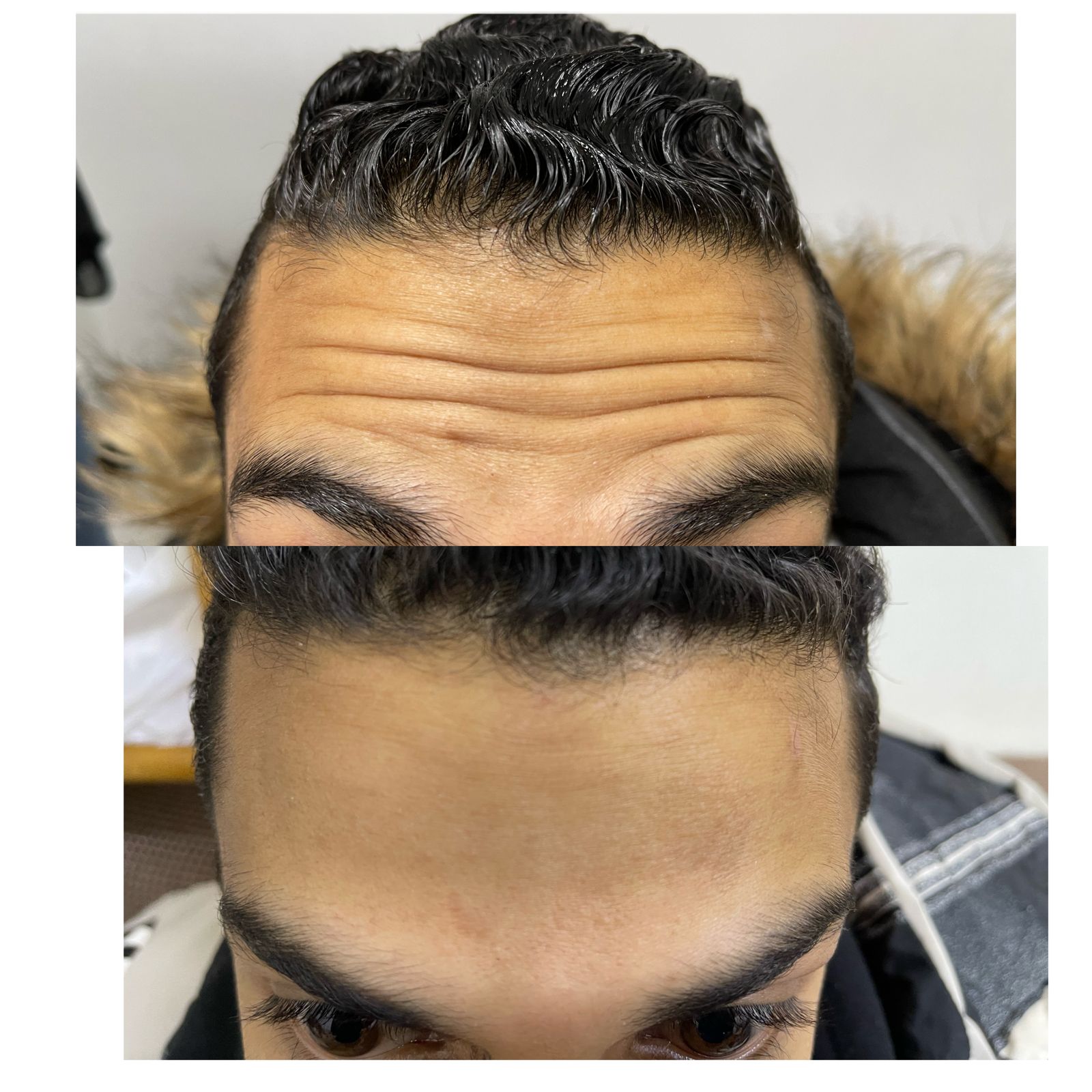 ازالة التجاعيد باستخدام البوتكس