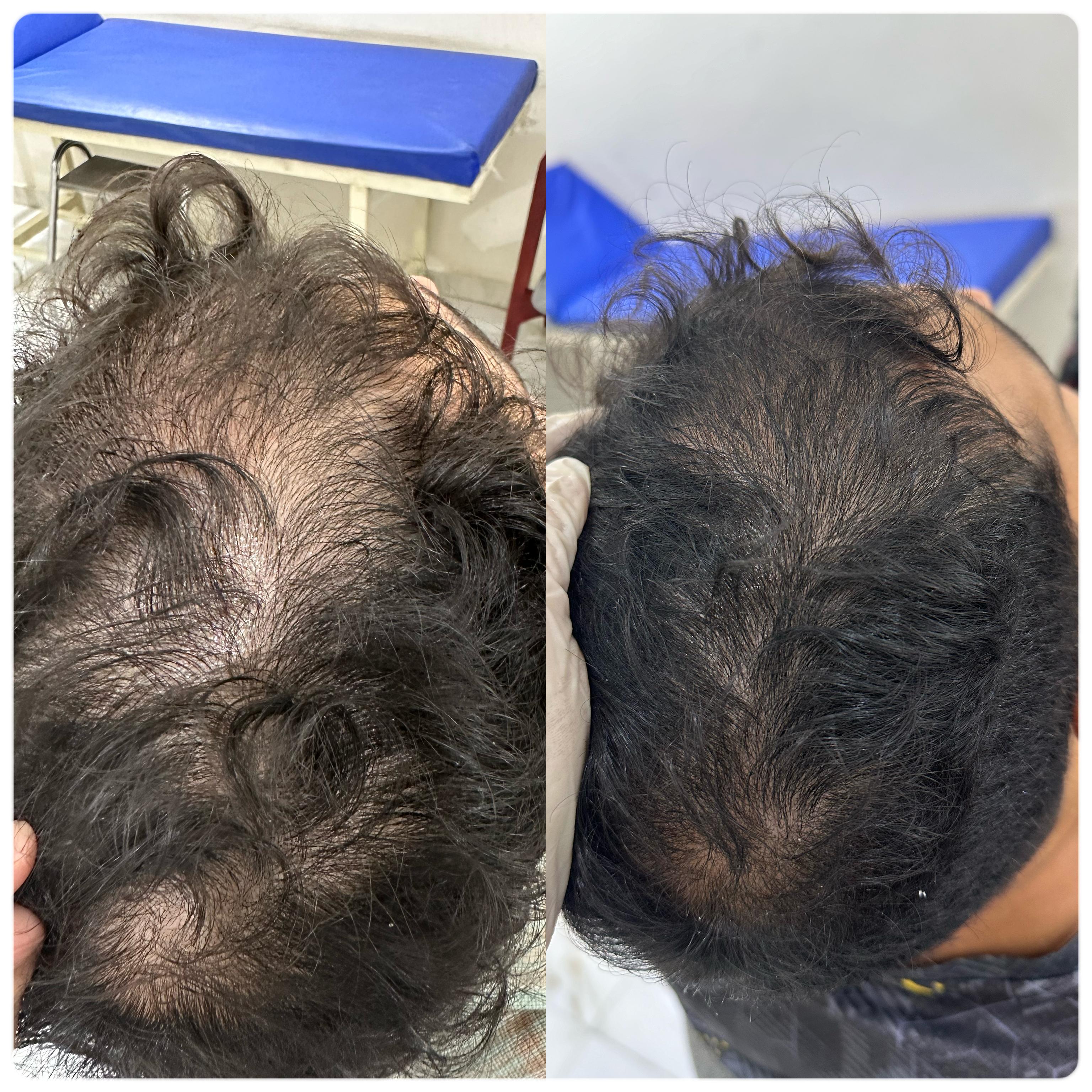 نتيجه جلسات الخلايا الجذعية قبل وبعد