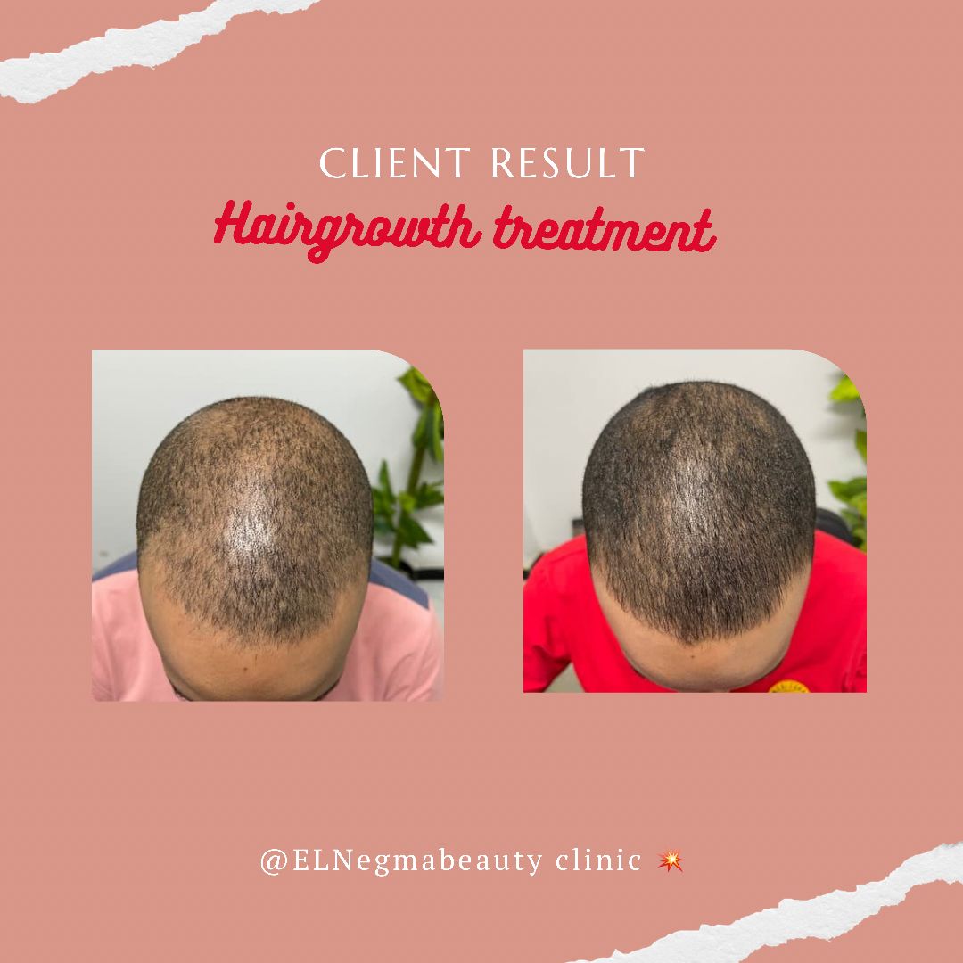 علاج تساقط الشعر عيادة النجمة