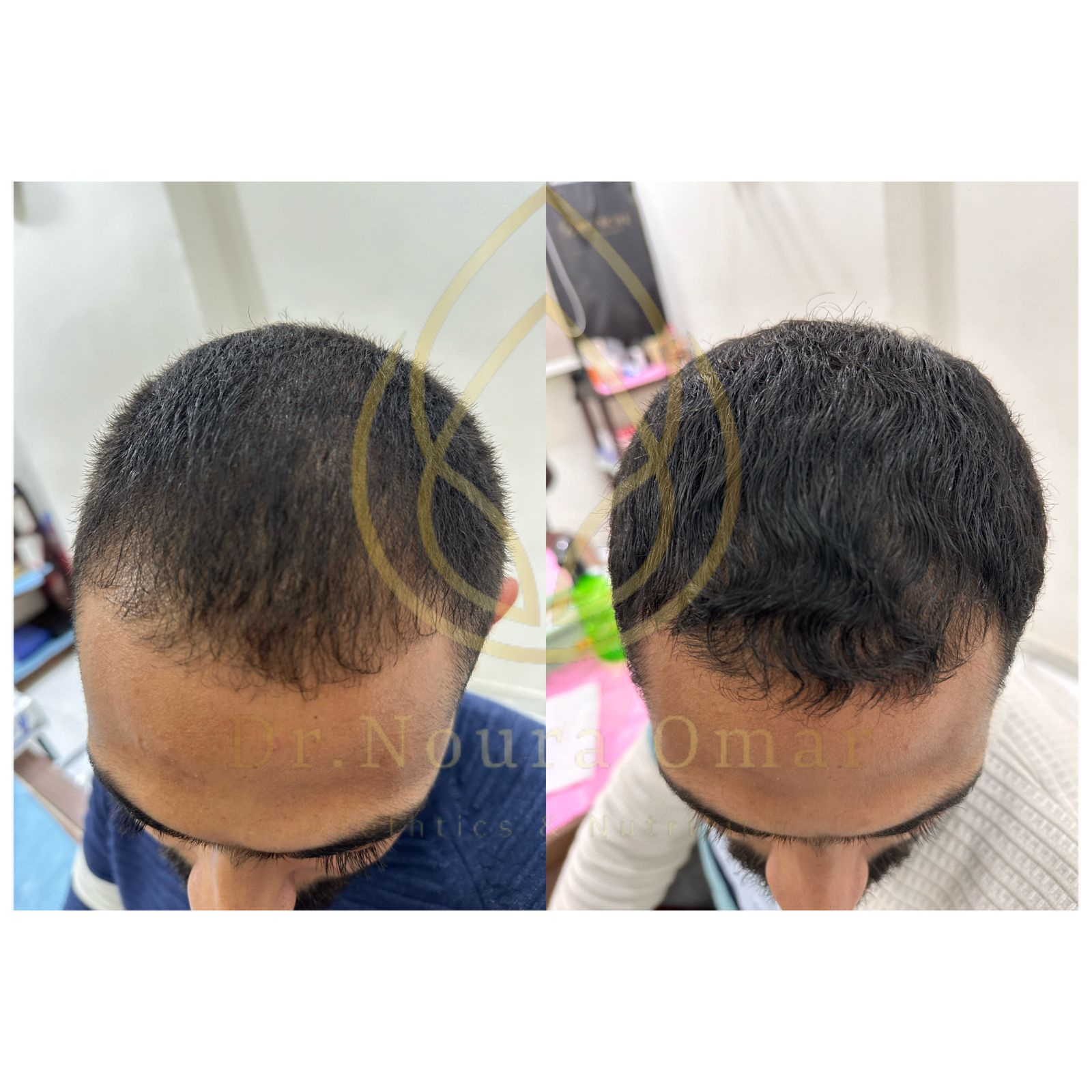 نتيجه جلسات الخلايا الجذعية قبل وبعد