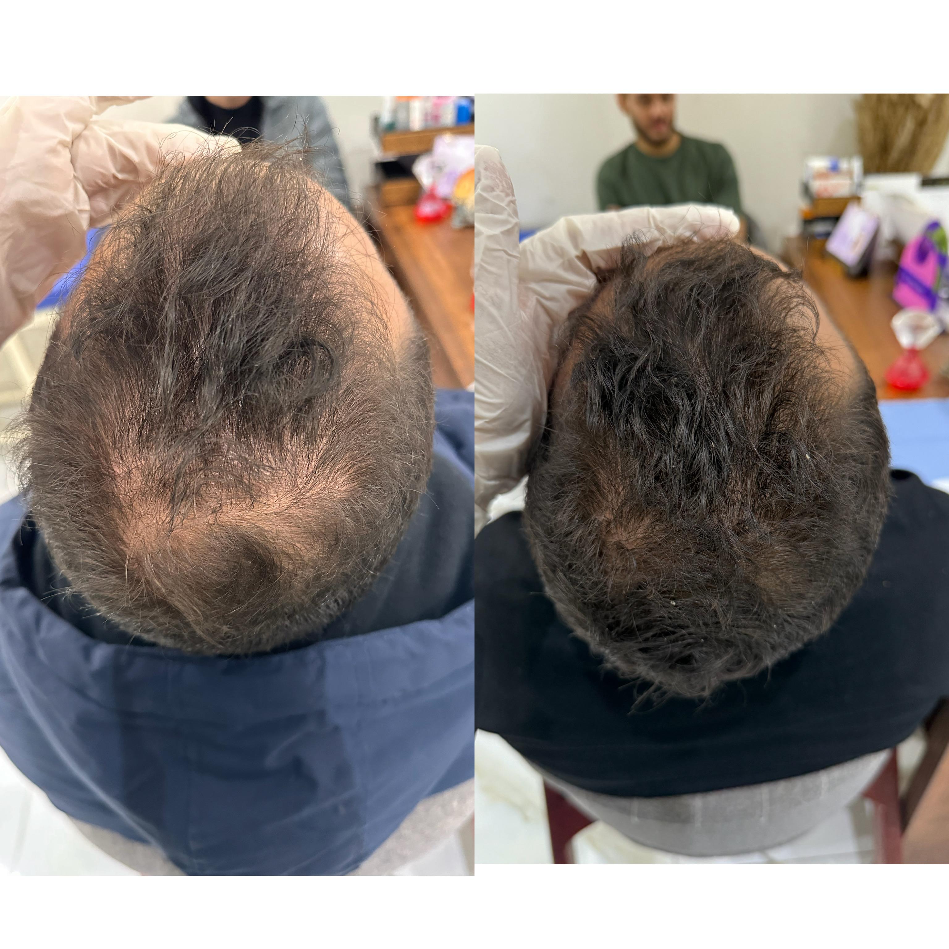 نتيجه جلسات الاكسوزوم للشعر