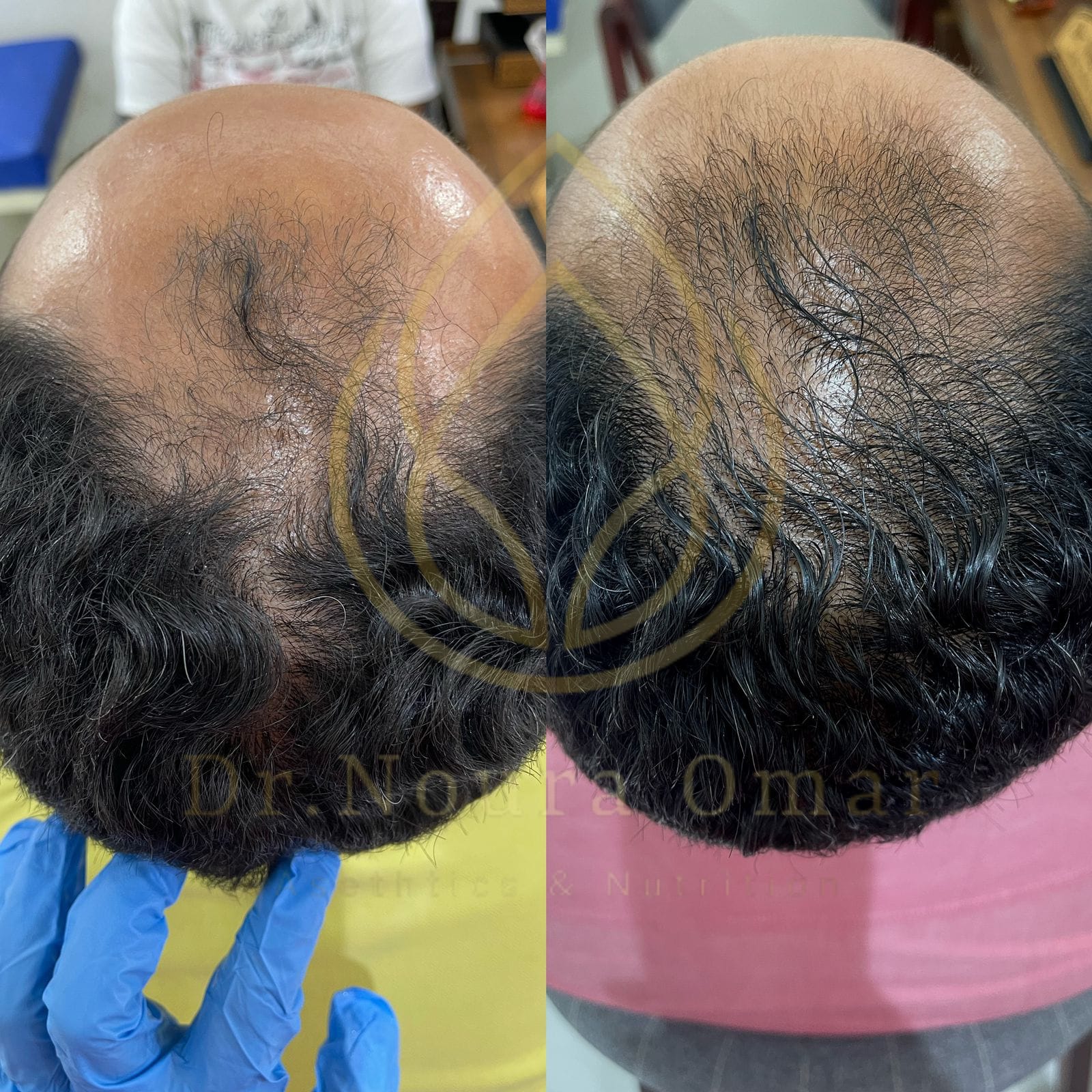 علاج الصلع الوراثي للشعر عيادة النجمة