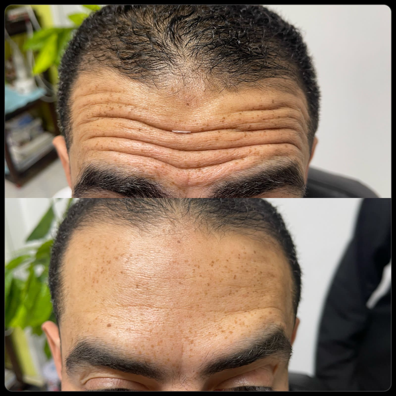 نتيجه جلسه البوتوكس للتجاعيد