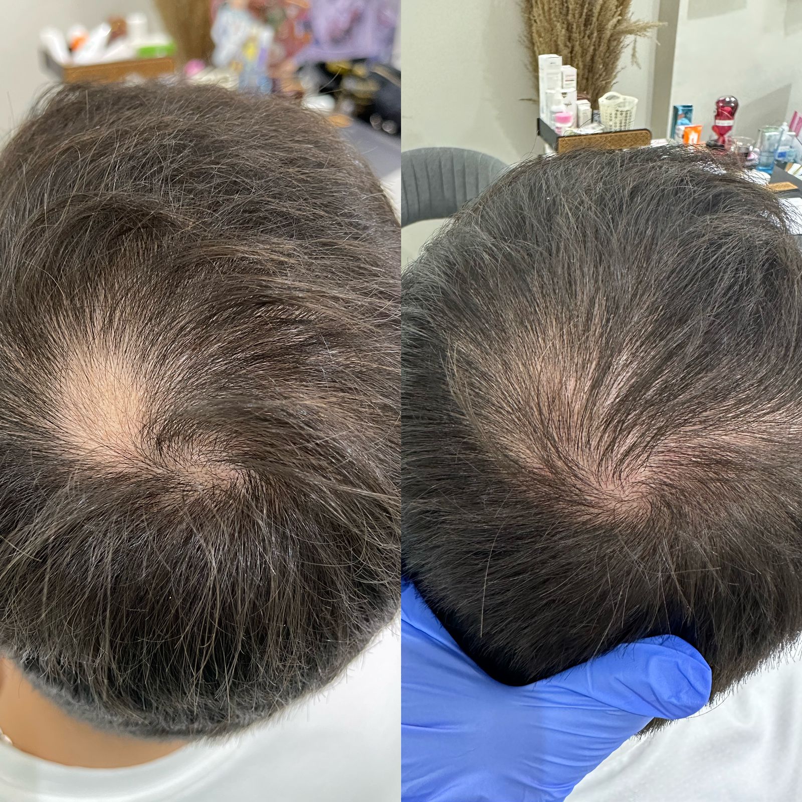 علاج ثعلبه الشعر عيادة النجمة