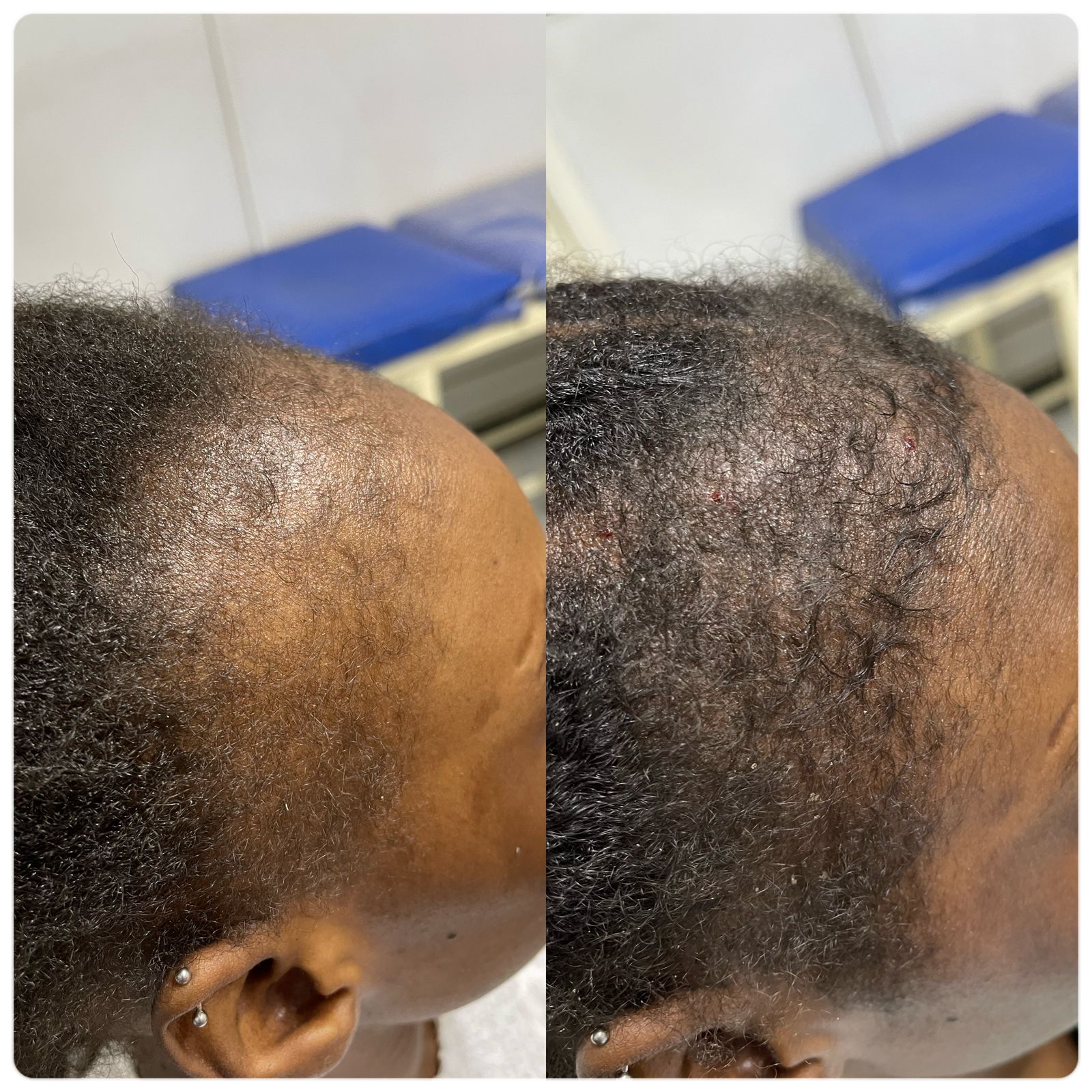 علاج الصلع الوراثي للشعر عيادة النجمة