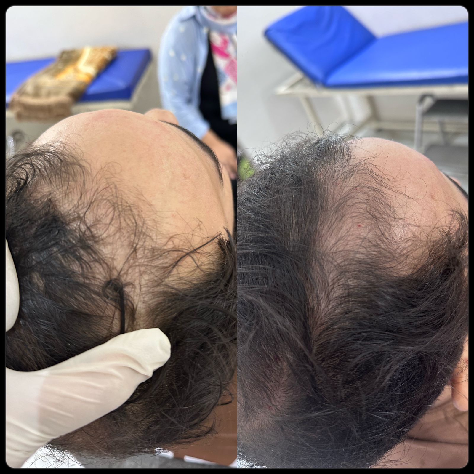 علاج الصلع الوراثي وتساقط الشعر والفراغات