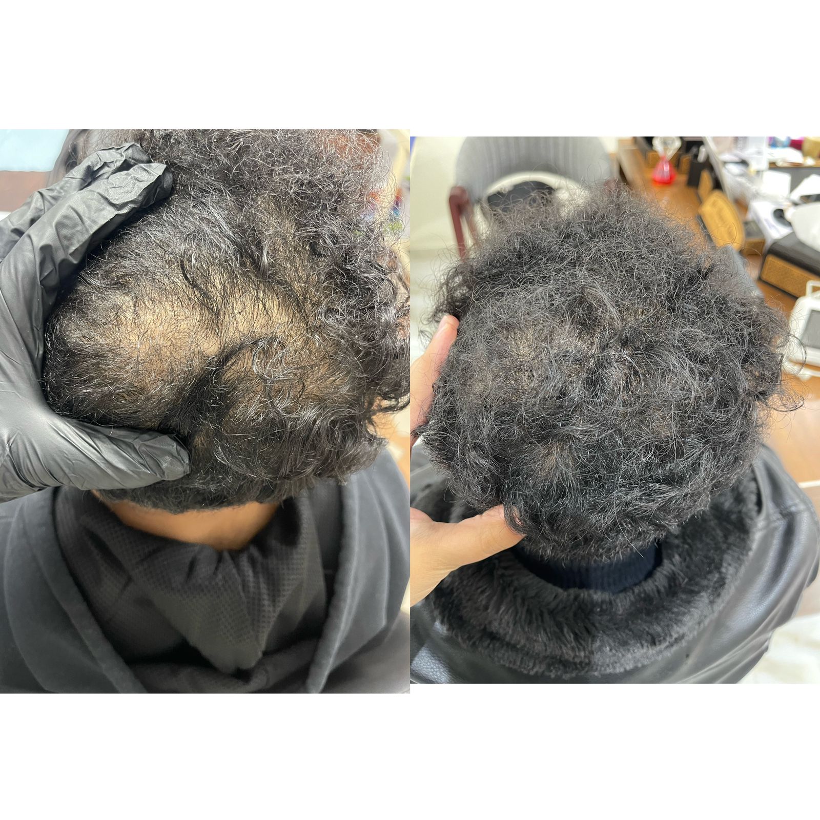 علاج تساقط الشعر عيادة النجمة