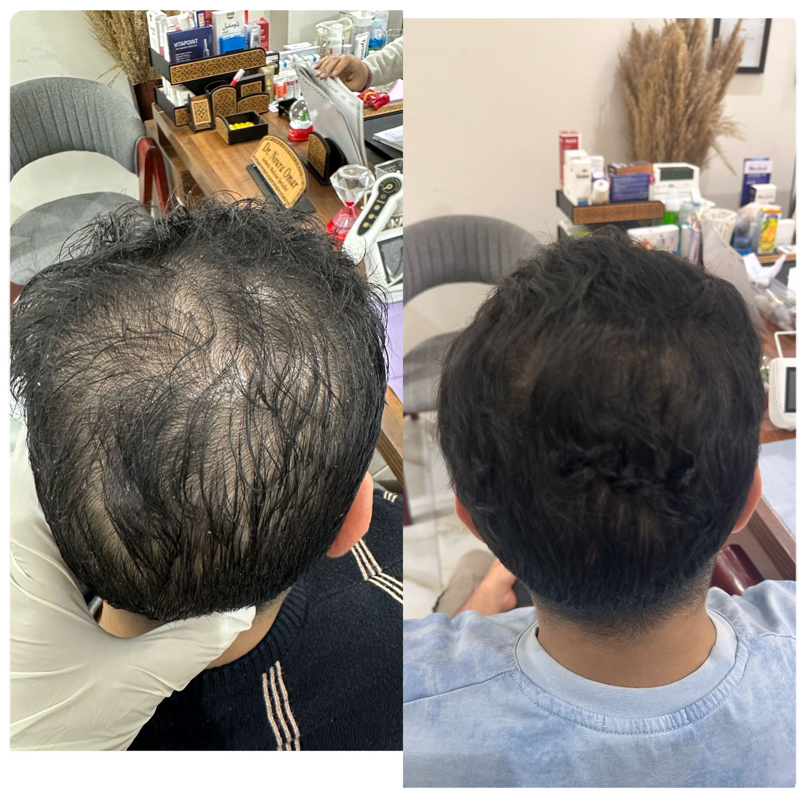 نتيجه جلسات الاكسوزوم للشعر