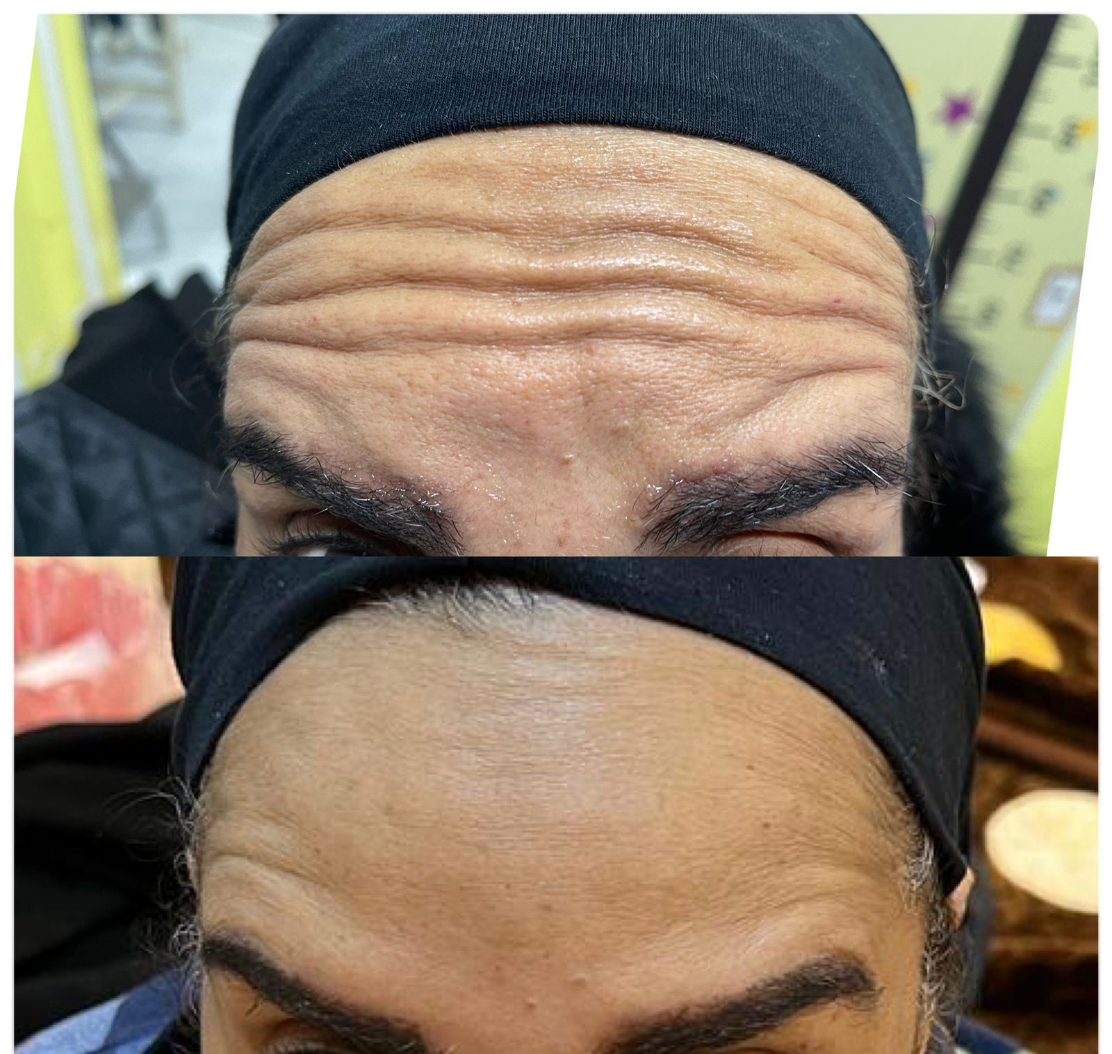 ازالة التجاعيد باستخدام البوتكس