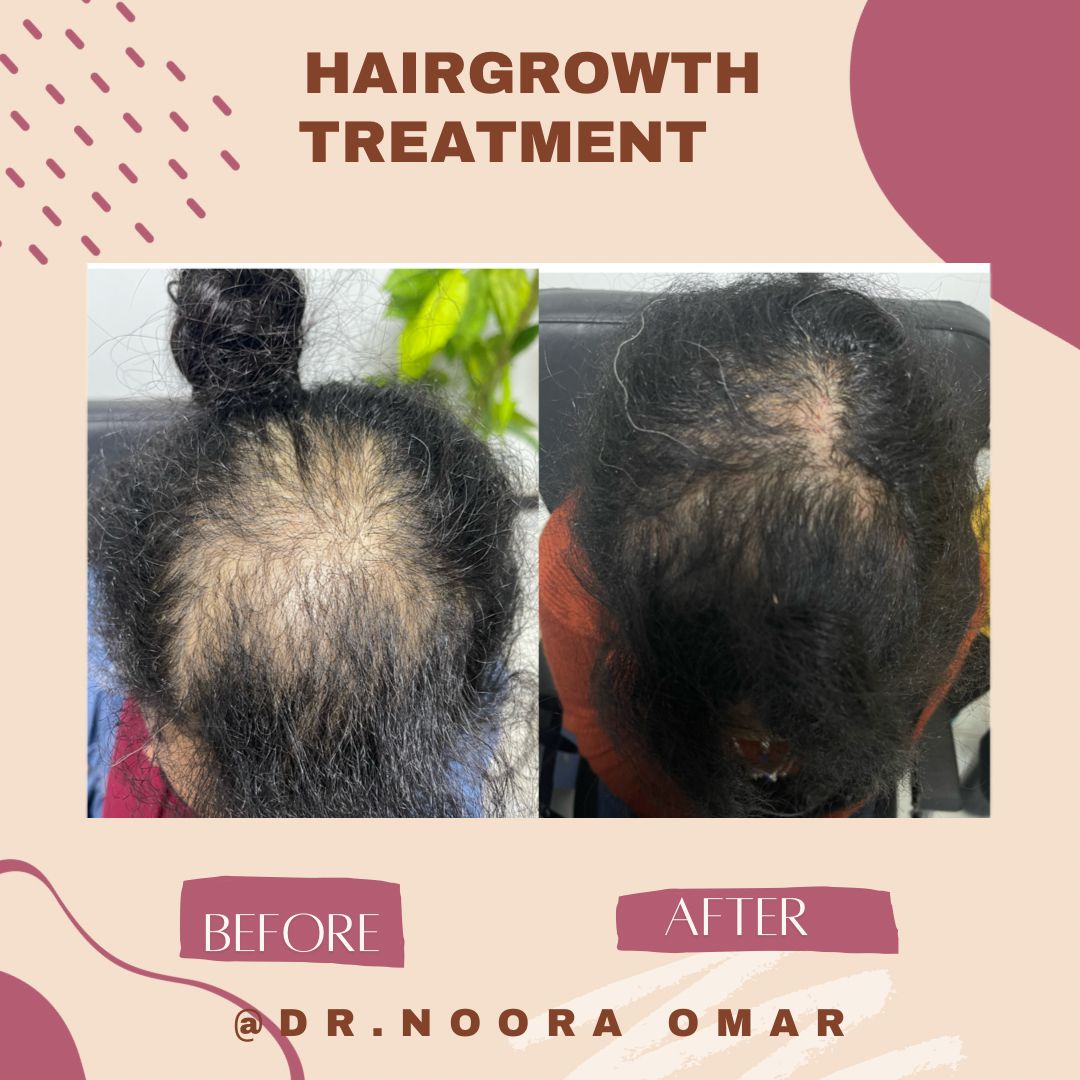 علاج الصلع الوراثي للشعر عيادة النجمة