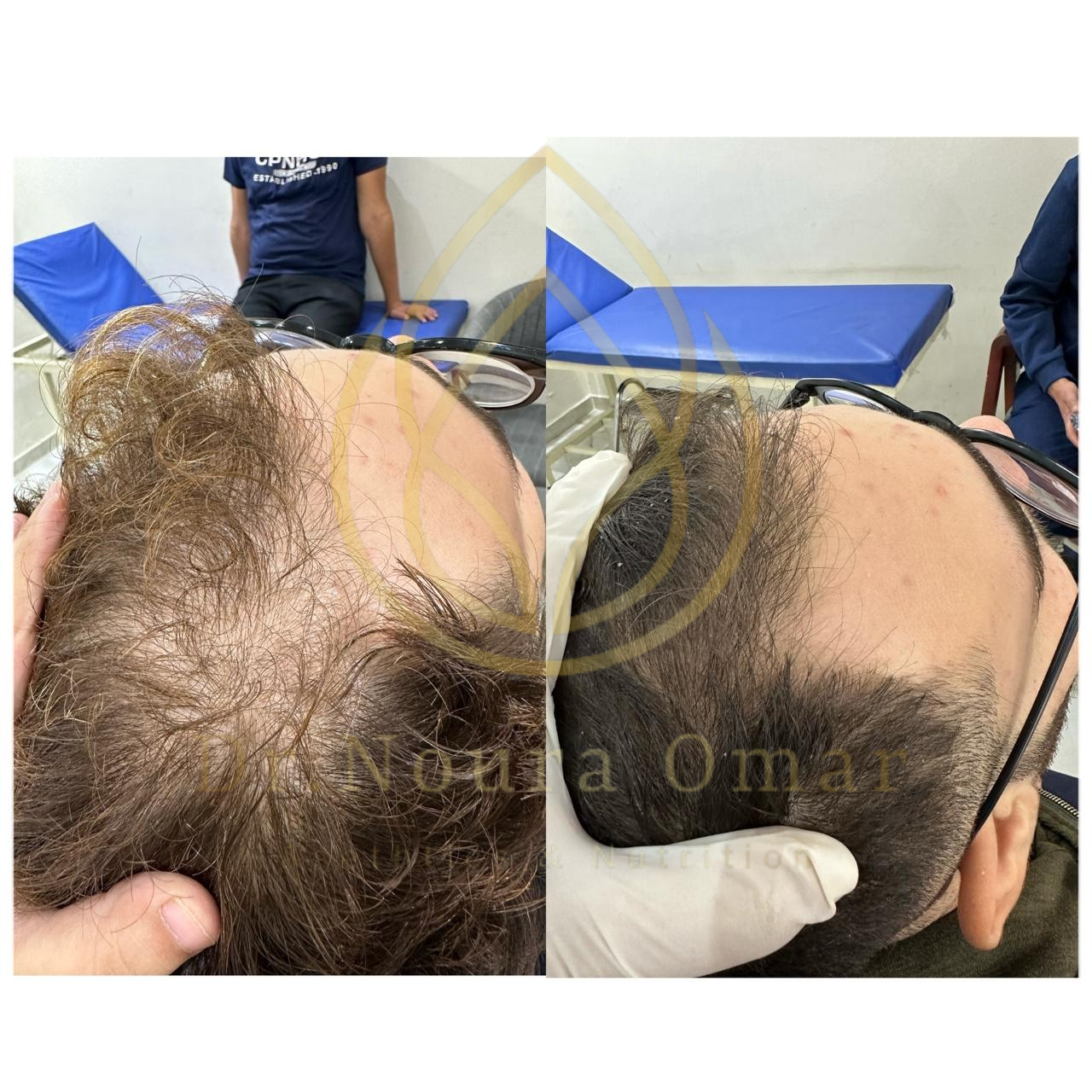 نتيجه جلسات الخلايا الجذعية قبل وبعد