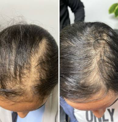 علاج تساقط الشعر عيادة النجمة