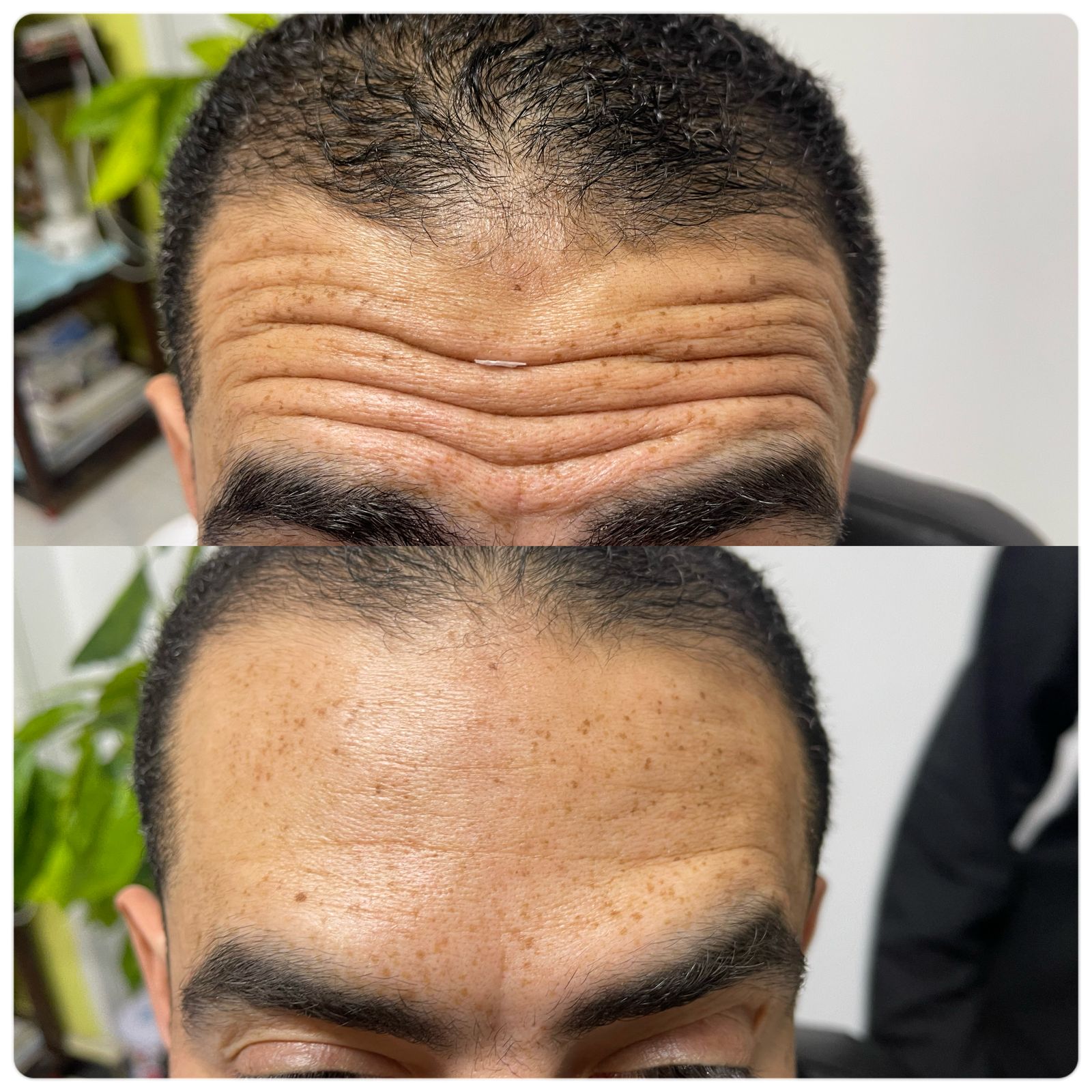 ازالة التجاعيد باستخدام البوتكس