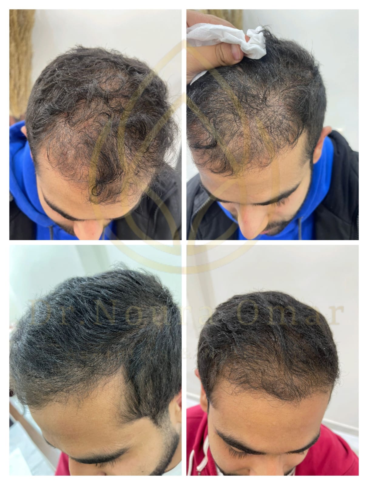 علاج الصلع الوراثي للشعر عيادة النجمة