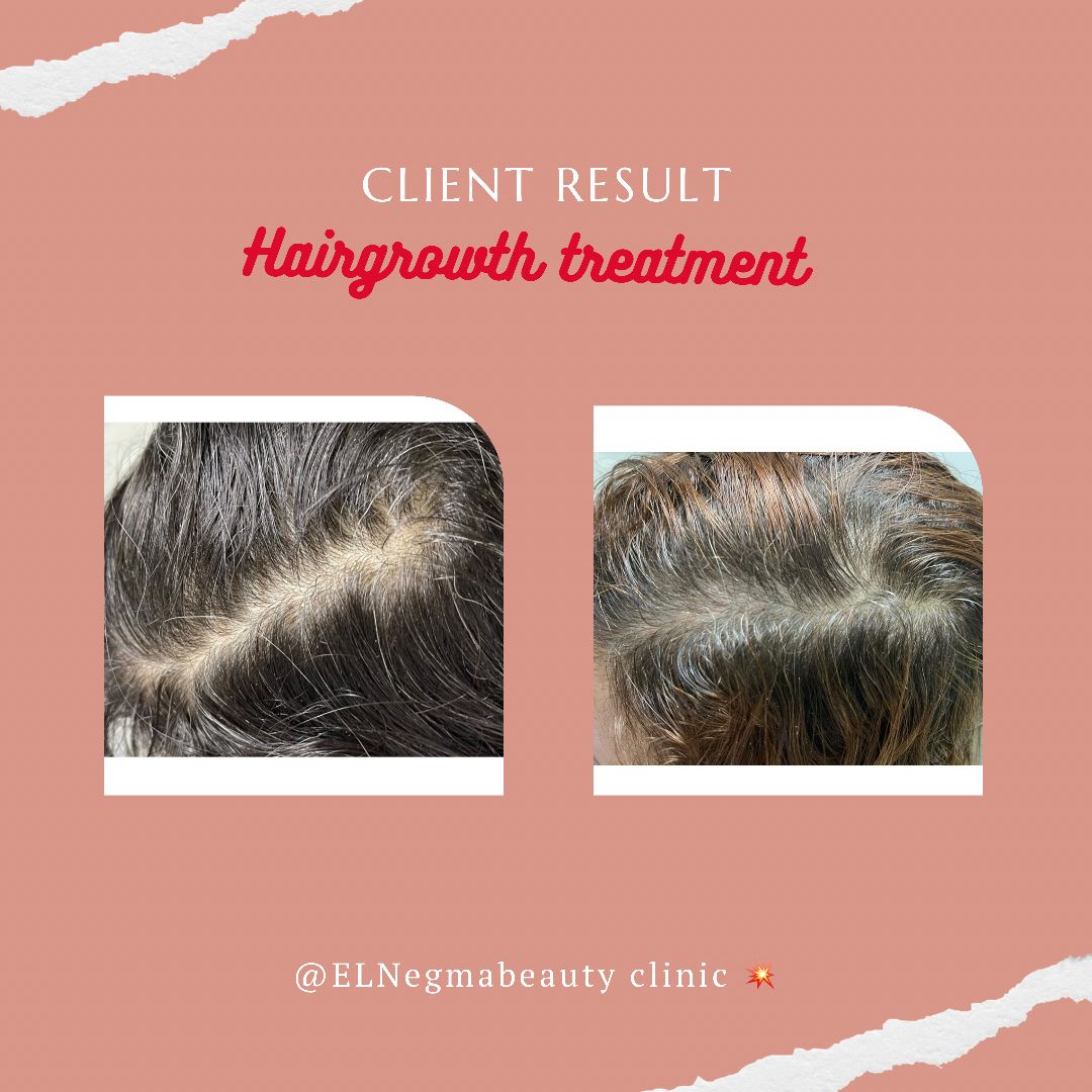 علاج تساقط الشعر عيادة النجمة