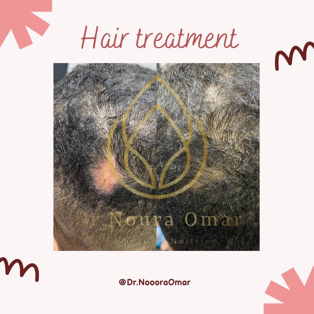 علاج ثعلبه الشعر عيادة النجمة
