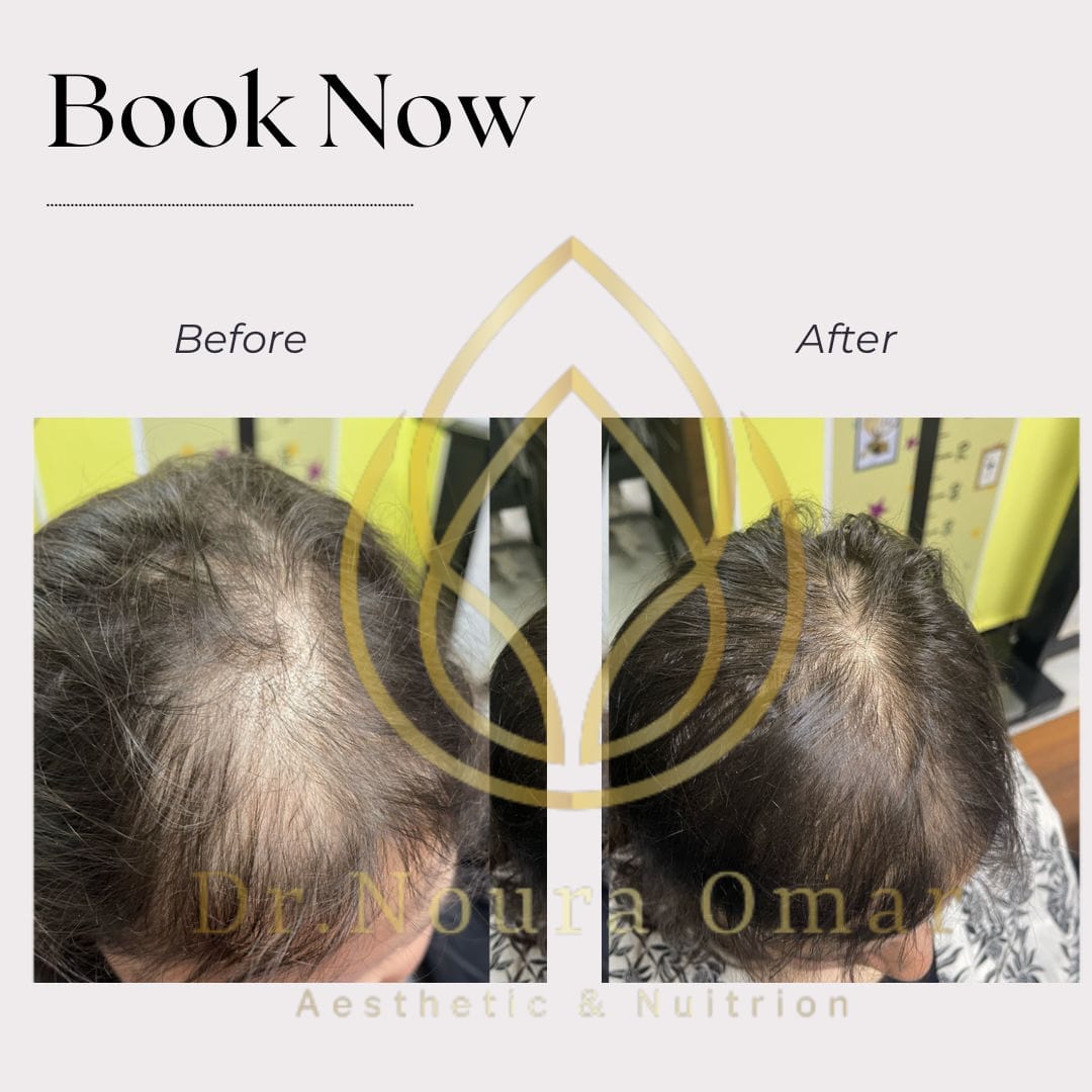 علاج الصلع الوراثي للشعر عيادة النجمة