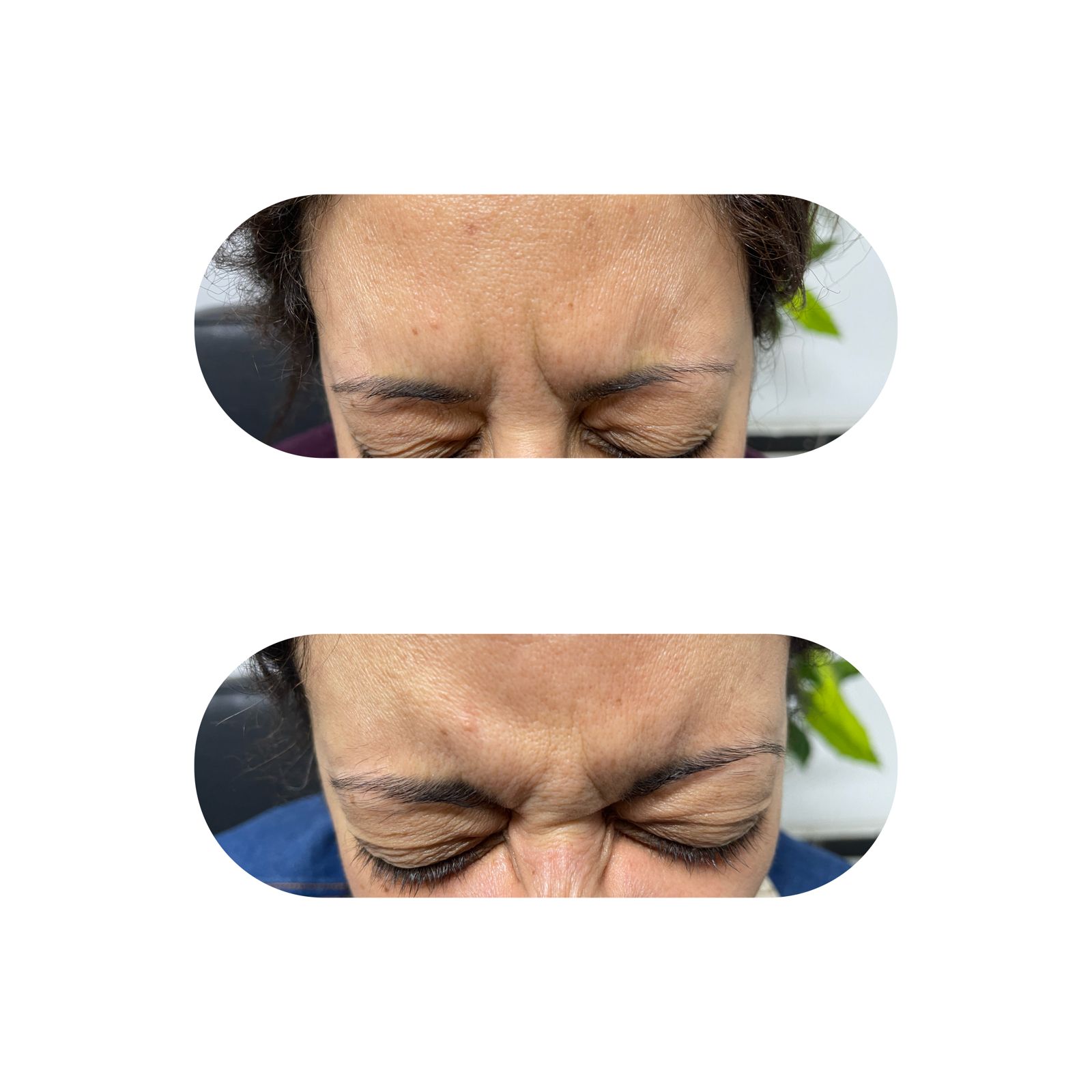 ازالة التجاعيد باستخدام البوتكس