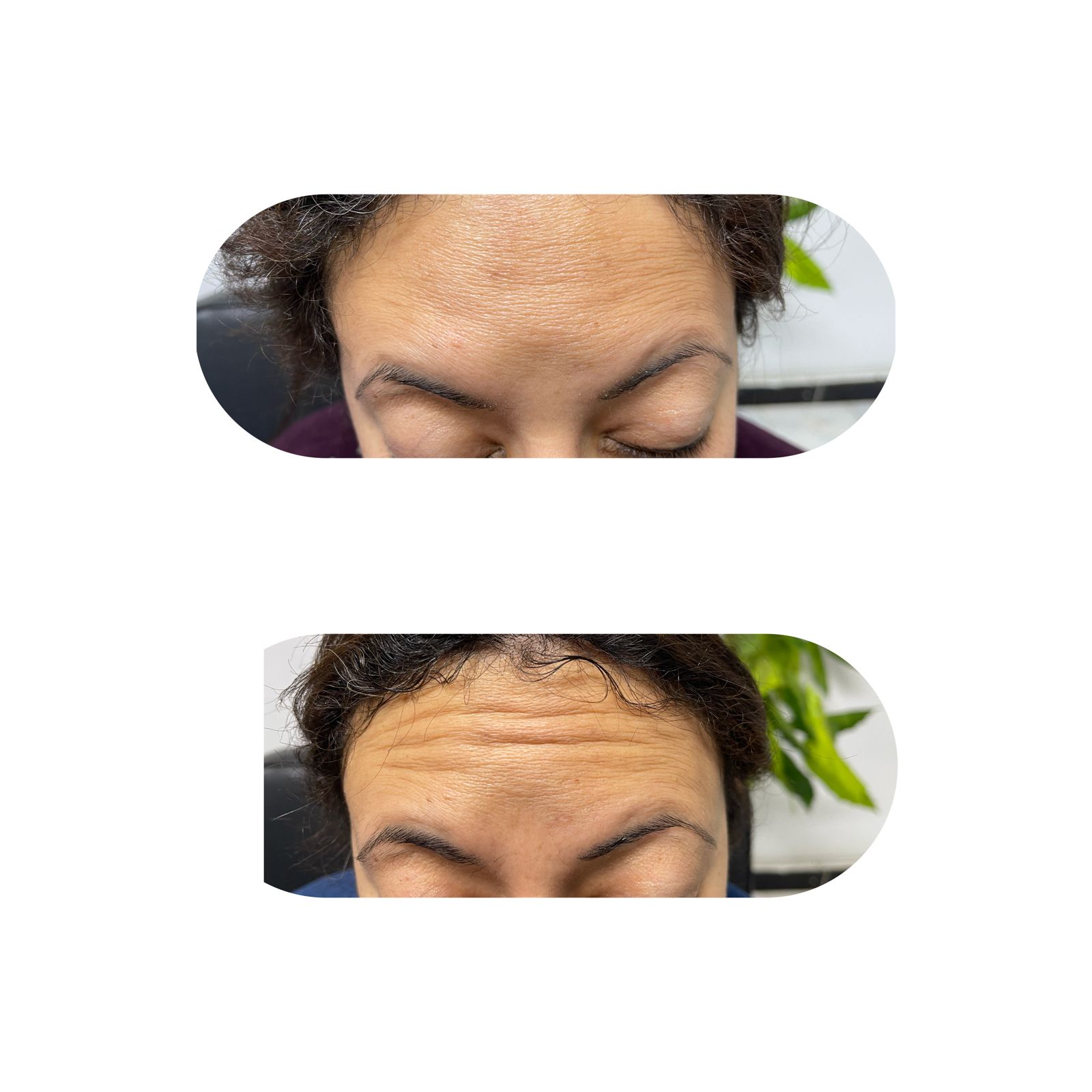 ازالة التجاعيد باستخدام البوتكس