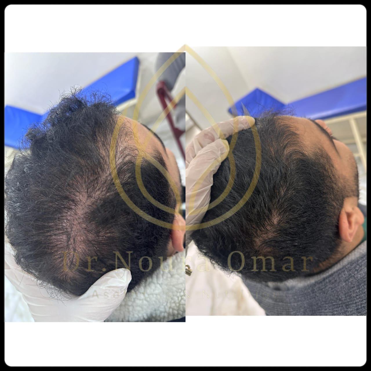 نتيجه جلسات الاكسوزوم للشعر