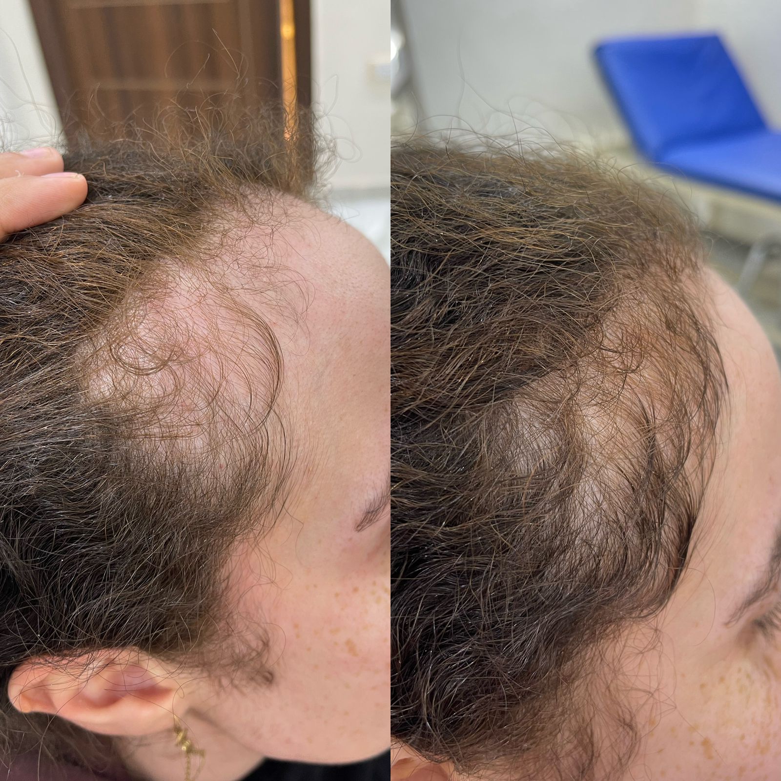 علاج الصلع الوراثي للشعر عيادة النجمة