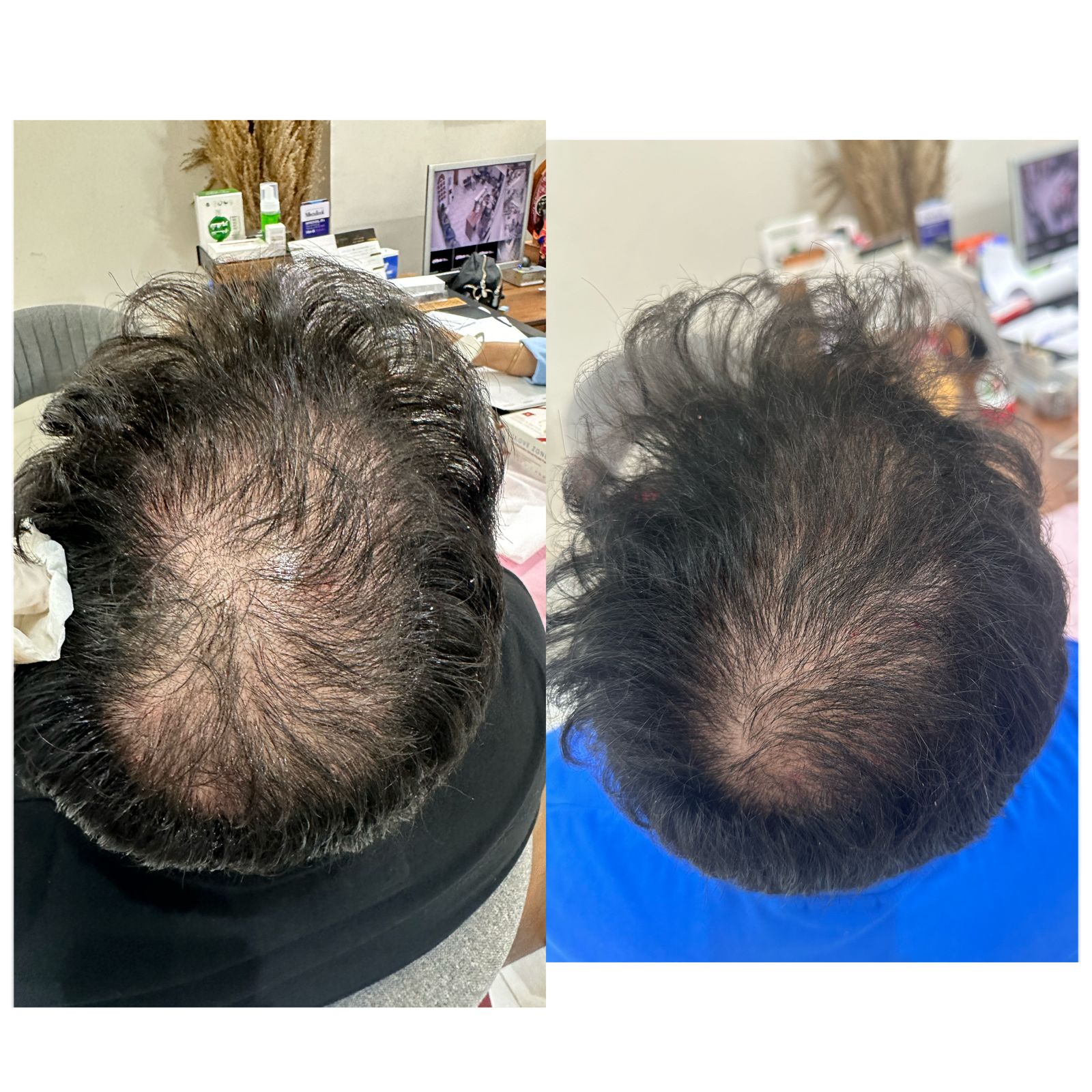 نتيجه جلسات الخلايا الجذعية قبل وبعد